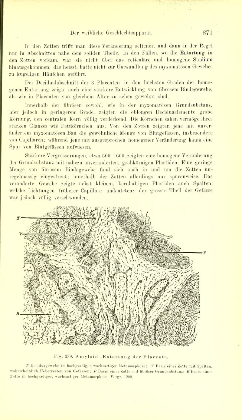 In den Zotten trifft man diese Veränderung seltener, und dann in der Regel nur in Abschnitten nahe dem soliden Theile. In den Fällen, wo die Entartung in den Zotten vorkam, war sie nicht über das reticuläre und homogene Stadium hinausgekommen, das heisst, hatte nicht zur Umwandlung des myxomatösen Gewebes zu kugeligen Häufchen geführt. Der Decidualabschnitt der 3 Placenten in den höchsten Graden der homo- genen Entartung zeigte auch eine stärkere Entwicklung von fibrösem Bindegewebe, als wir in Placenten von gleichem Alter zu sehen gewohnt sind. Innerhalb der fibrösen sowohl, wie in der myxomatösen Grundsubstanz, hier jedoch in geringerem Grade, zeigten die oblongen Deciduaelemente grobe Körnung, den centralen Kern völlig verdeckend. Die Körnchen sahen vermöge ihres starken Glanzes wie Fettkörnchen aus. Von den Zotten zeigten jene mit unver- ändertem myxomatösen Bau die gewöhnliche Menge von Blutgefässen, insbesondere von Capillaren; während jene mit ausgesprochen homogener Veränderung kaum eine Spur von Blutgefässen aufwiesen. Stärkere Vergrösserungen. etwa 500—600, zeigten eine homogene Veränderung der Grundsubstanz mit nahezu unveränderten, grobkörnigen Plastiden. Eine geringe Menge von fibrösem Bindegewebe fand sich auch in und um die Zotten un- regelmässig eingestreut; innerhalb der Zotten allerdings nur spurenweise. Das veränderte Gewebe zeigte nebst kleinen, kernhaltigen Plastiden auch Spalten, welche Lichtungen früherer Capillare andeuteten; der grösste Theil der Gefässe war jedoch völlig verschwunden. Fig. 379. Amyloid -Entartung der Placenta, 1 Deeiduagewebe in hochgradiger wachsartiger Metamorphose; V Basis einer Zotte mit Spalten, wahrscheinlich Ueberresten von Gefässen; /'Basis einer Zotte mit fibröser Grundsubstanz; B Basis einer Zotte in hochgradiger, wachsartiger Metamorphose. Vergr. 1200,