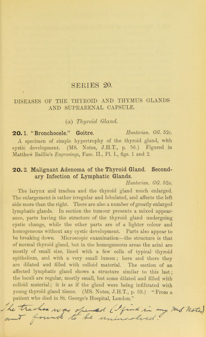 DISEASES OF THE THYEOID AND THYMUS GLANDS AND SUPEARENAL CAPSULE. (a) Thyroid Gland. 20.1. “ Bronchocele.” Goitre. Hunterian. GG. 52c. A specimen of simple li3^pertrophy of the thyroid gland, with cystic development. (MS. Notes, J.H.T., p. 56.) Figured in Matthevv Baillie’s Engravings, Fasc. II., PI. L, figs. 1 and 2. 20.2. Malignant Adenoma of the Thyroid Gland. Second- ary Infection of Lymphatic Glands. Hunterian. GG. 52a. The larynx and trachea and the thyroid gland much enlarged. The enlargement is rather irregular and lobulated, and affects the left side more than the right. There are also a number of greatly enlarged lymphatic glands. In section the tumour presents a mixed appear- ance, parts having the structure of the thyroid gland undergoing cystic change, while the other parts are of a lighter colour and homogeneous without any cystic development. Parts also appear to be breaking down. Microscopic examination—the structure is that of normal thyroid gland, but in the homogeneous areas the acini are mostly of small size, lined with a few cells of typical thyroid epithelium, and with a very small lumen; here and there they are dilated and filled with colloid material. The section of an affected lymphatic gland shows a structure similar to this last; the loculi are regular, mostly small, but some dilated and filled with colloid material; it is as if the gland were being infiltrated with young thyroid gland tissue. (MS. Notes, J.H.T., p. 55.) “From a patient who died in St. George’s Hospital, London.”