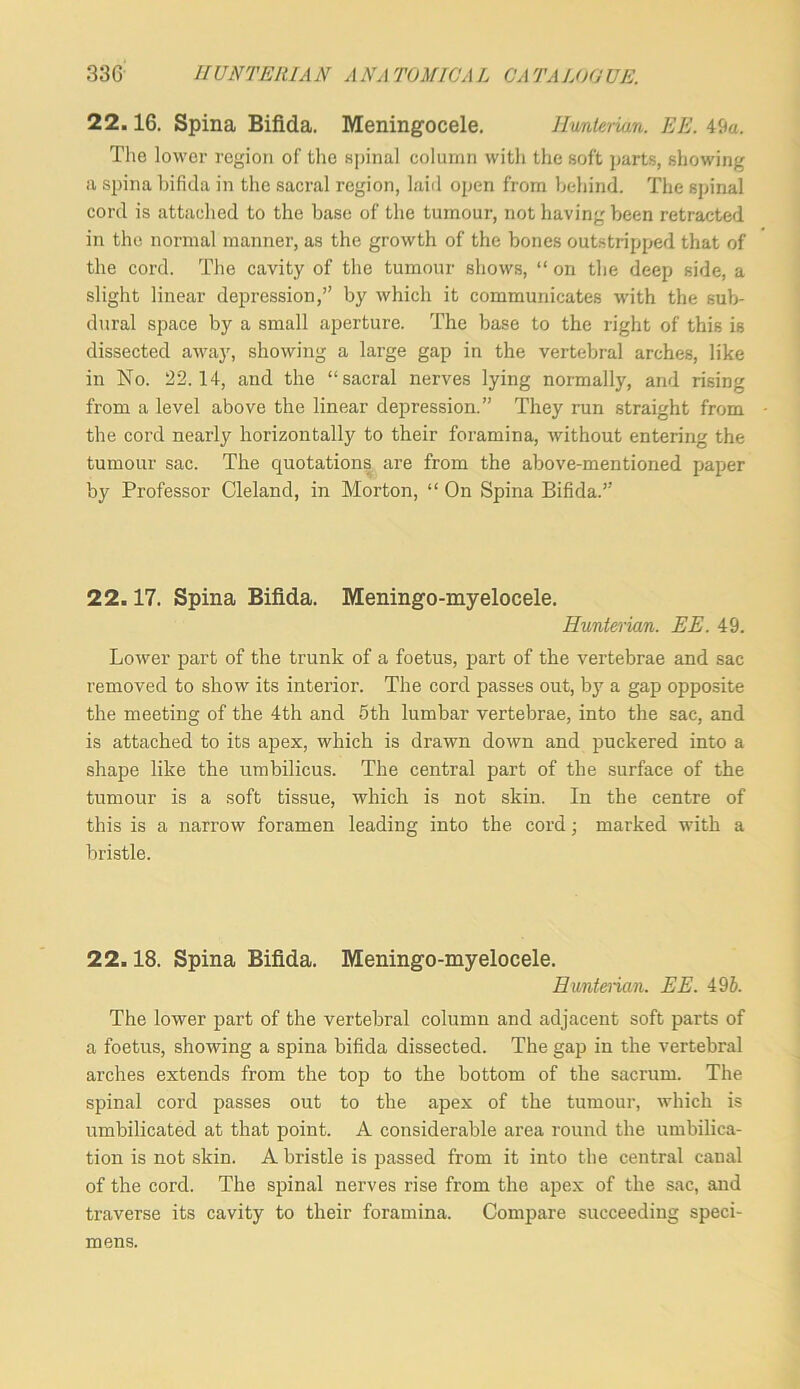 22.16. Spina Bifida. Meningocele. Jlmterian. EE. 49a. The lower region of the spinal column with the soft parts, showing a spina bifida in the sacral region, laid open from behind. The spinal cord is attached to the base of the tumour, not having been retracted in the normal manner, as the growth of the bones outstripped that of the cord. The cavity of the tumour shows, “ on the deep side, a slight linear depression,” by which it communicates with the sub- dural spjice by a small aperture. The base to the right of this is dissected away, showing a large gap in the vertebral arches, like in No. 22.14, and the “sacral nerves lying normally, and rising from a level above the linear depression.” They run straight from the cord nearly horizontally to their foramina, without entering the tumour sac. The quotations are from the above-mentioned paper by Professor Cleland, in Morton, “ On Spina Bifida.” 22.17. Spina Bifida. Meningo-myelocele. Hunterian. EE. 49. Lower part of the trunk of a foetus, part of the vertebrae and sac removed to show its interior. The cord passes out, bj' a gap opposite the meeting of the 4th and 5th lumbar vertebrae, into the sac, and is attached to its apex, which is drawn down and puckered into a shape like the umbilicus. The central part of the surface of the tumour is a soft tissue, which is not skin. In the centre of this is a narrow foramen leading into the cord; marked with a bristle. 22.18. Spina Bifida. Meningo-myelocele. Hunterian. EE. 49J. The lower part of the vertebral column and adjacent soft parts of a foetus, showing a spina bifida dissected. The gap in the vertebral arches extends from the top to the bottom of the sacrum. The spinal coi’d passes out to the apex of the tumour, which is umbilicated at that point. A considerable area round the umbilica- tion is not skin. A bristle is passed from it into the central canal of the cord. The spinal nerves rise from the apex of the sac, and traverse its cavity to their foramina. Compare succeeding speci- mens.