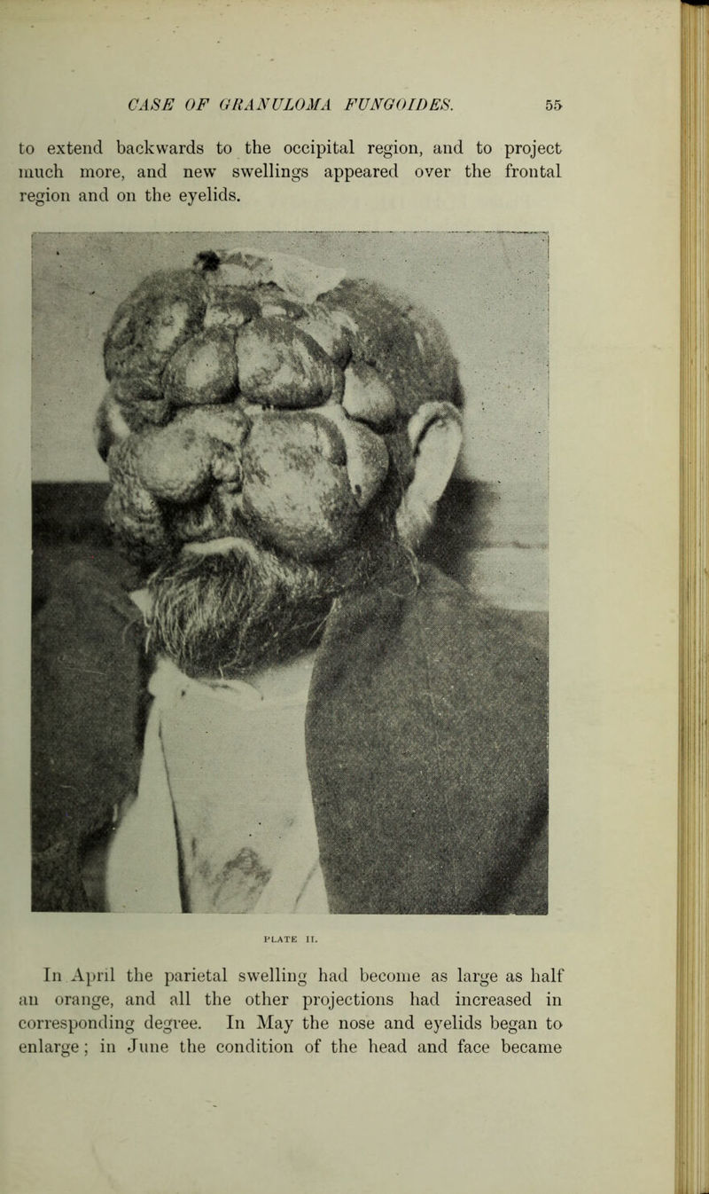 to extend backwards to the occipital region, and to project much more, and new swellings appeared over the frontal region and on the eyelids. PLATE II. In April the parietal swelling had become as large as half an orange, and all the other projections had increased in corresponding degree. In May the nose and eyelids began to enlarge; in June the condition of the head and face became