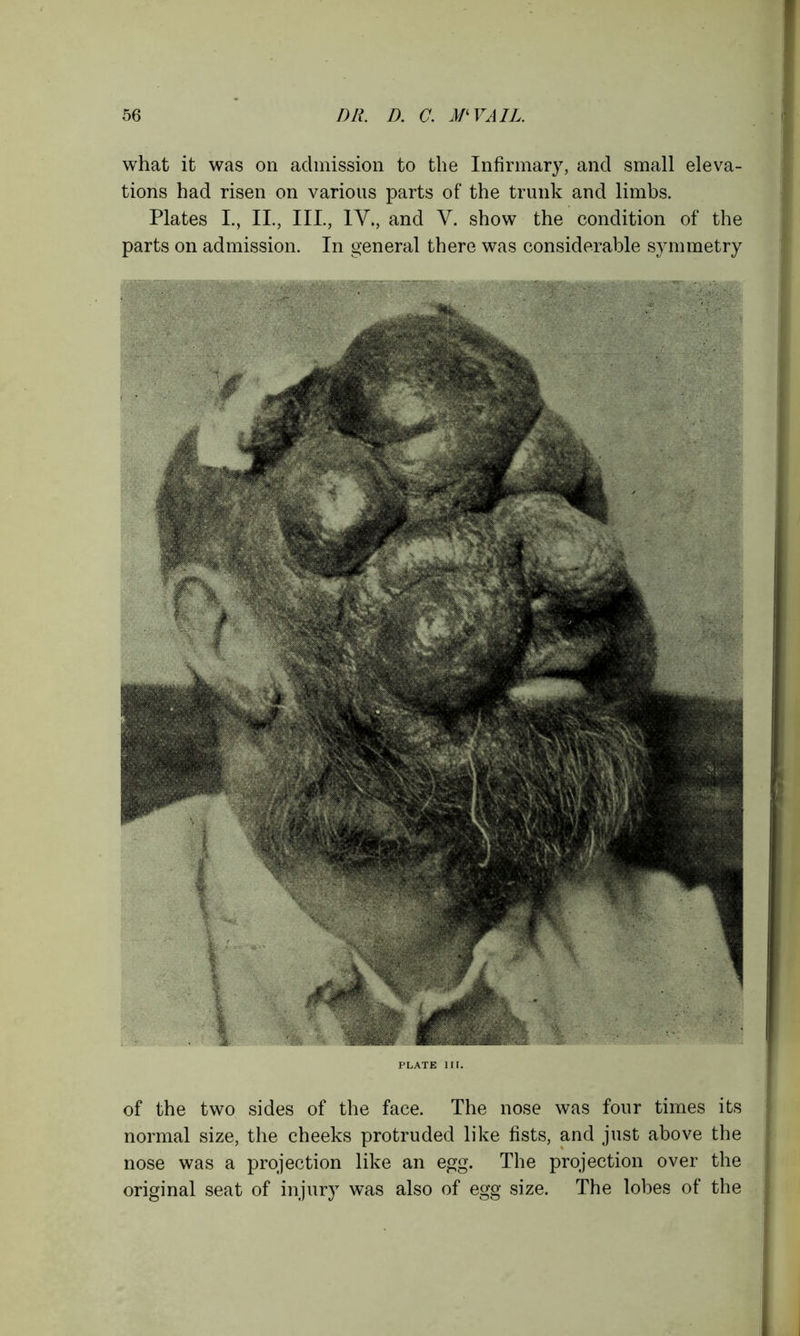 r what it was on admission to the Infirmary, and small eleva- tions had risen on various parts of the trunk and limbs. Plates I., II., III., IV., and V. show the condition of the parts on admission. In general there was considerable symmetry of the two sides of the face. The nose was four times its normal size, the cheeks protruded like fists, and just above the nose was a projection like an egg. The projection over the original seat of injury was also of egg size. The lobes of the i