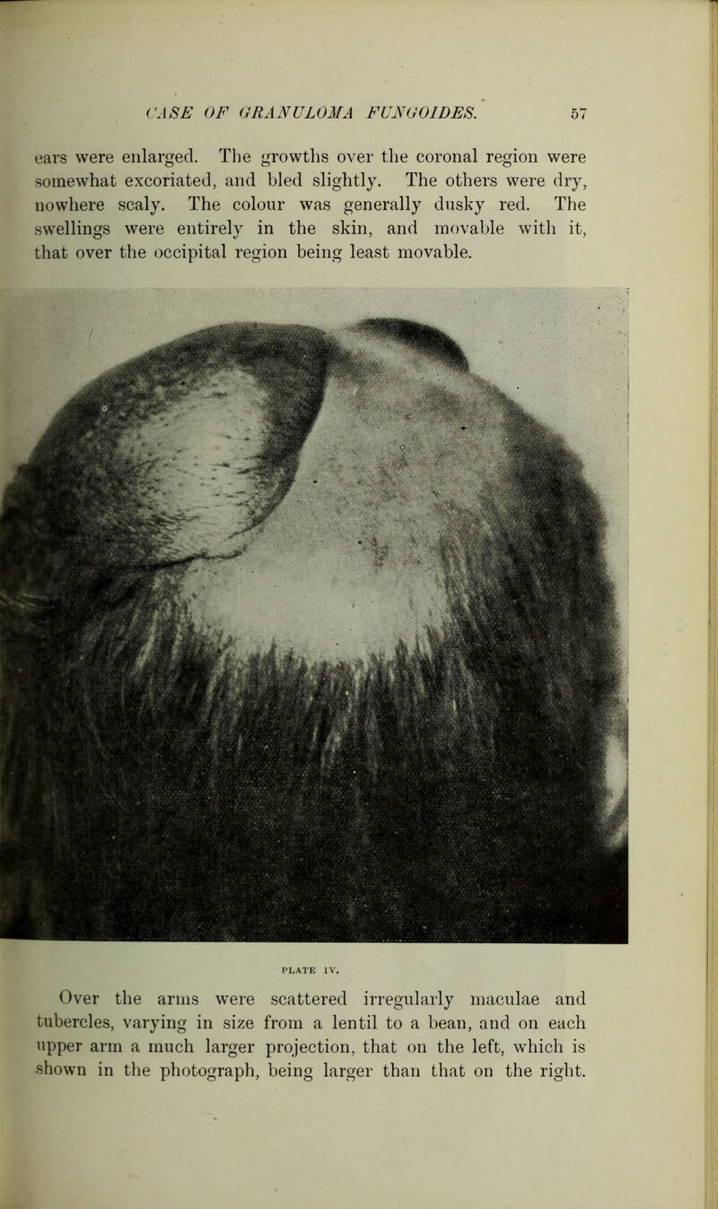 ears were enlarged. The growths over the coronal region were somewhat excoriated, and bled slightly. The others were dry, nowhere scaly. The colour was generally dusky red. The swellings were entirely in the skin, and movable with it, that over the occipital region being least movable. PLATE IV. Over the arms were scattered irregularly maculae and tubercles, varying in size from a lentil to a bean, and on each upper arm a much larger projection, that on the left, which is shown in the photograph, being larger than that on the right.