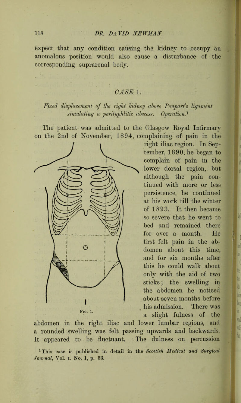 expect that any condition causing the kidney to occupy an anomalous position would also cause a disturbance of the corresponding suprarenal body. CASE 1. Fixed displacement of the right kidney above Pouparfs ligament simulating a perityphlitic abscess. OperationA The patient was admitted to the Glasgow Koyal Infirmary on the 2nd of November, 1894, complaining of pain in the right iliac region. In Sep- tember, 1890, he began to complain of pain in the lower dorsal region, but although the pain con- tinued with more or less persistence, he continued at his work till the winter of 1893. It then became so severe that he went to bed and remained there for over a month. He first felt pain in the ab- domen about this time, and for six months after this he could walk about only with the aid of two sticks; the swelling in the abdomen he noticed about seven months before his admission. There was a slight fulness of the abdomen in the right iliac and lower lumbar regions, and a rounded swelling was felt passing upwards and backwards. It appeared to be fluctuant. The dulness on percussion 1This case is published in detail in the Scottish Medical and Surgical Journal Vol. i. No. 1, p. 53.