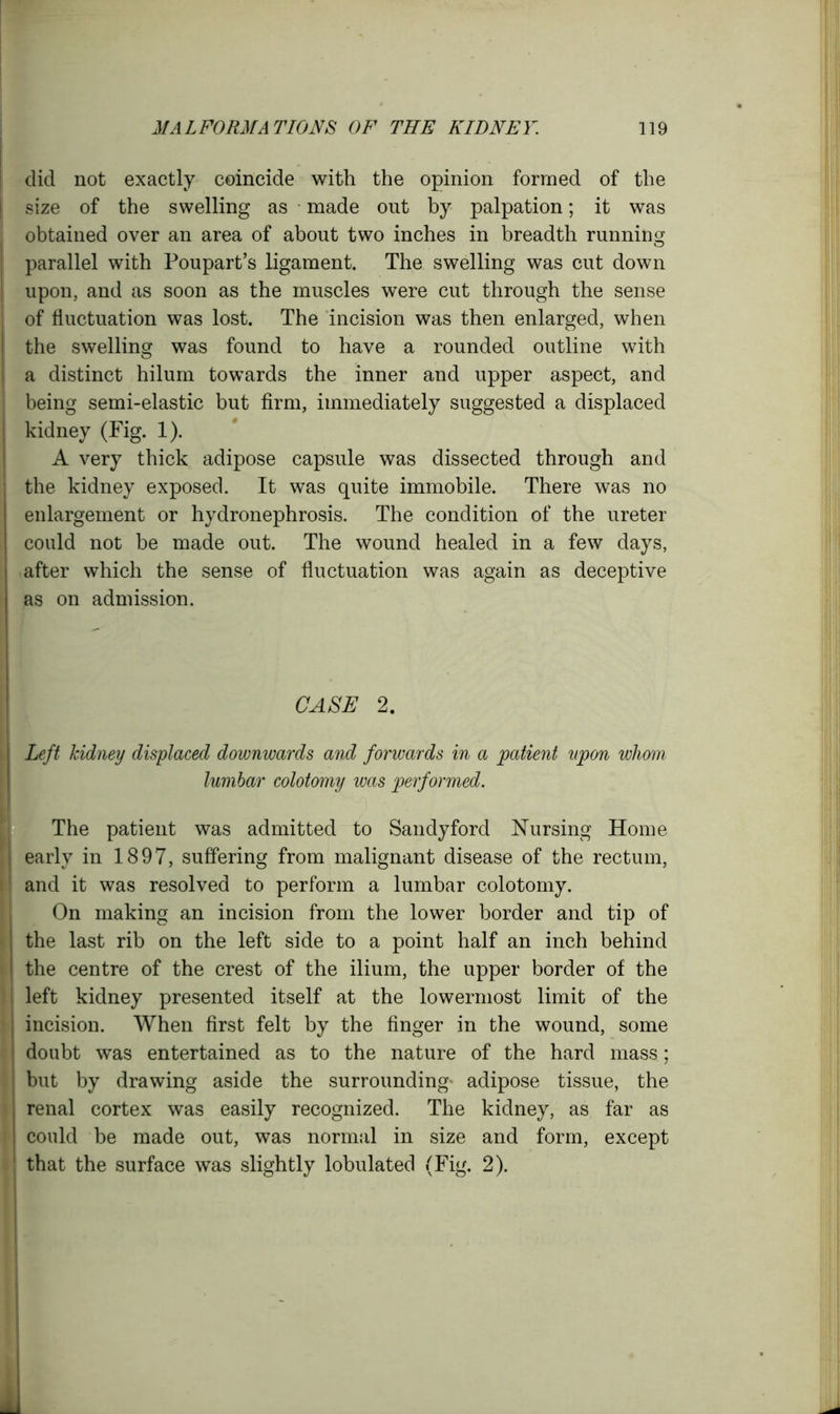 did not exactly coincide with the opinion formed of the size of the swelling as made out by palpation; it was obtained over an area of about two inches in breadth running parallel with Poupart’s ligament. The swelling was cut down upon, and as soon as the muscles were cut through the sense of fluctuation was lost. The incision was then enlarged, when I the swelling was found to have a rounded outline with a distinct hilum towards the inner and upper aspect, and being semi-elastic but firm, immediately suggested a displaced kidney (Fig. 1). A very thick adipose capsule was dissected through and the kidney exposed. It was quite immobile. There was no j enlargement or hydronephrosis. The condition of the ureter could not be made out. The wound healed in a few days, after which the sense of fluctuation was again as deceptive as on admission. CASE 2. Left kidney displaced downwards and forwards in a patient upon whom lumbar colotomy was performed. The patient was admitted to Sandy ford Nursing Home I early in 1897, suffering from malignant disease of the rectum, 1 and it was resolved to perform a lumbar colotomy. On making an incision from the lower border and tip of the last rib on the left side to a point half an inch behind the centre of the crest of the ilium, the upper border of the | left kidney presented itself at the lowermost limit of the incision. When first felt by the finger in the wound, some doubt was entertained as to the nature of the hard mass; ! but by drawing aside the surrounding- adipose tissue, the renal cortex was easily recognized. The kidney, as far as could be made out, was normal in size and form, except that the surface was slightly lobulated (Fig. 2). ' I