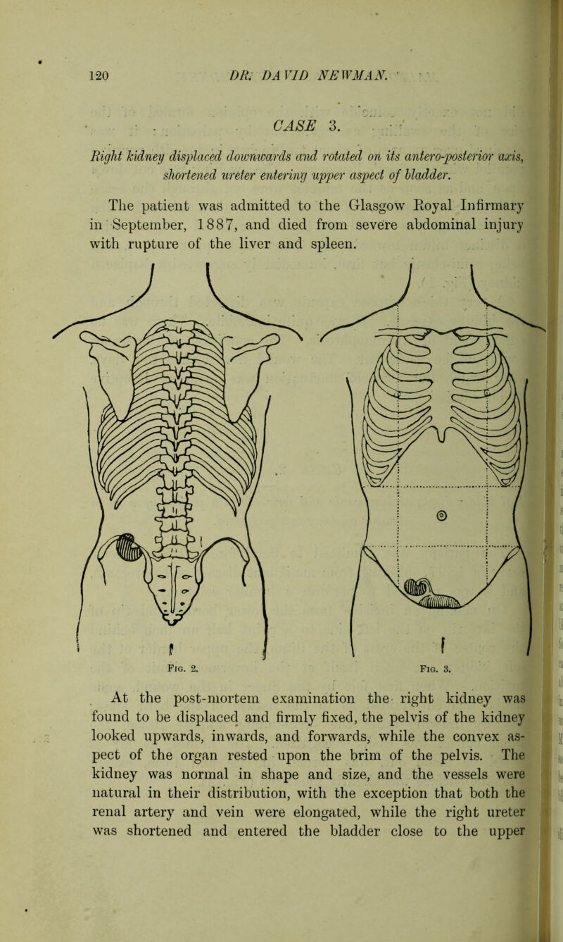 CASE 3. Right kidney displaced downwards mid rotated on its antero-posterior axis, shortened ureter entering upper aspect of bladder. The patient was admitted to the Glasgow Royal Infirmary in September, 1887, and died from severe abdominal injury with rupture of the liver and spleen. At the post-mortem examination the right kidney was found to be displaced and firmly fixed, the pelvis of the kidney looked upwards, inwards, and forwards, while the convex as- pect of the organ rested upon the brim of the pelvis. The kidney was normal in shape and size, and the vessels were natural in their distribution, with the exception that both the renal artery and vein were elongated, while the right ureter was shortened and entered the bladder close to the upper