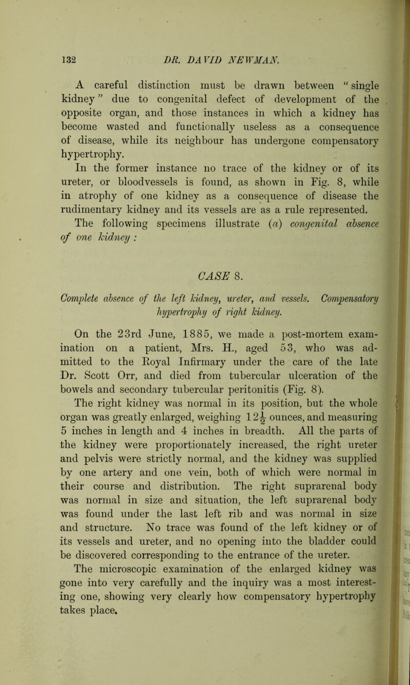 A careful distinction must be drawn between “ single kidney ” due to congenital defect of development of the opposite organ, and those instances in which a kidney has become wasted and functionally useless as a consequence of disease, while its neighbour has undergone compensatory hypertrophy. In the former instance no trace of the kidney or of its ureter, or bloodvessels is found, as shown in Fig. 8, while in atrophy of one kidney as a consequence of disease the rudimentary kidney and its vessels are as a rule represented. The following specimens illustrate (a) congenital absence of one kidney : CASE 8. Complete absence of the left kidney, ureter, and vessels. Compensatory hypertrophy of right kidney. On the 23rd June, 1885, we made a post-mortem exam- ination on a patient, Mrs. H., aged 53, who was ad- mitted to the Royal Infirmary under the care of the late Dr. Scott Orr, and died from tubercular ulceration of the bowels and secondary tubercular peritonitis (Fig. 8). The right kidney was normal in its position, but the whole organ was greatly enlarged, weighing 12^- ounces, and measuring 5 inches in length and 4 inches in breadth. All the parts of the kidney were proportionately increased, the right ureter and pelvis were strictly normal, and the kidney was supplied by one artery and one vein, both of which were normal in their course and distribution. The right suprarenal body was normal in size and situation, the left suprarenal body was found under the last left rib and was normal in size and structure. No trace was found of the left kidney or of its vessels and ureter, and no opening into the bladder could be discovered corresponding to the entrance of the ureter. The microscopic examination of the enlarged kidney was gone into very carefully and the inquiry was a most interest- ing one, showing very clearly how compensatory hypertrophy takes place.