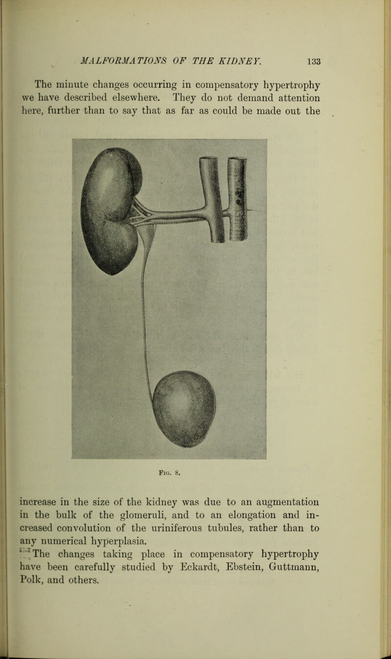 The minute changes occurring in compensatory hypertrophy we have described elsewhere. They do not demand attention here, further than to say that as far as could be made out the Fig. 8. increase in the size of the kidney was due to an augmentation in the bulk of the glomeruli, and to an elongation and in- creased convolution of the uriniferous tubules, rather than to any numerical hyperplasia. t rtThe changes taking place in compensatory hypertrophy have been carefully studied by Eckardt, Ebstein, Guttmann, Polk, and others.