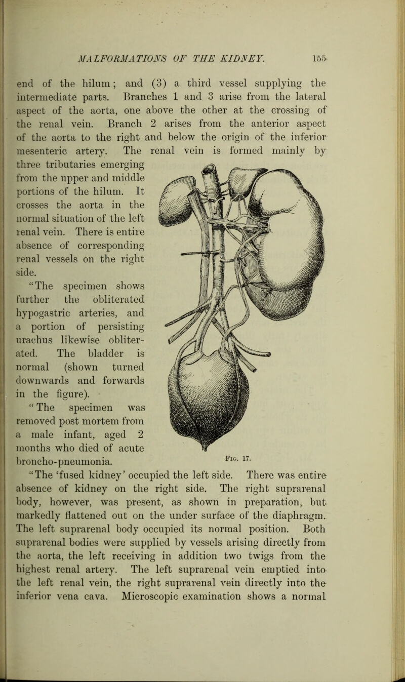 end of the hilum; and (3) a third vessel supplying the intermediate parts. Branches 1 and 3 arise from the lateral aspect of the aorta, one above the other at the crossing of the renal vein. Branch 2 arises from the anterior aspect of the aorta to the right and below the origin of the inferior mesenteric artery. The renal vein is formed mainly by three tributaries emerging from the upper and middle portions of the hilum. It crosses the aorta in the normal situation of the left renal vein. There is entire absence of corresponding renal vessels on the right side. “ The specimen shows further the obliterated hypogastric arteries, and a portion of persisting urachus likewise obliter- ated. The bladder is normal (shown turned downwards and forwards in the figure). “ The specimen was removed post mortem from a male infant, aged 2 months who died of acute broncho-pneumonia. “The ‘fused kidney’ occupied the left side. There was entire absence of kidney on the right side. The right suprarenal body, however, was present, as shown in preparation, but markedly flattened out on the under surface of the diaphragm. The left suprarenal body occupied its normal position. Both suprarenal bodies were supplied by vessels arising directly from the aorta, the left receiving in addition two twigs from the highest renal artery. The left suprarenal vein emptied into the left renal vein, the right suprarenal vein directly into the inferior vena cava. Microscopic examination shows a normal Fig. 17. -