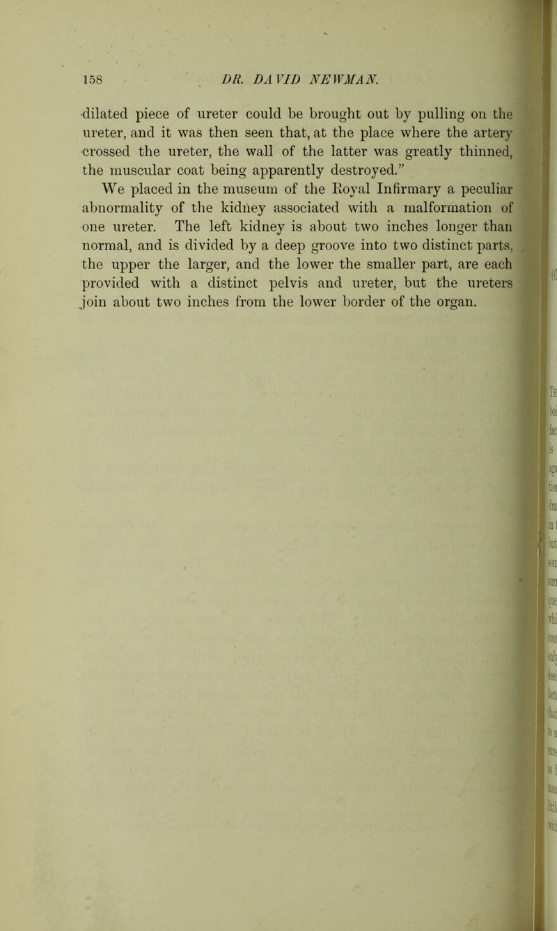 dilated piece of ureter could be brought out by pulling on the ureter, and it was then seen that, at the place where the artery crossed the ureter, the wall of the latter was greatly thinned, the muscular coat being apparently destroyed.” We placed in the museum of the Royal Infirmary a peculiar abnormality of the kidney associated with a malformation of one ureter. The left kidney is about two inches longer than normal, and is divided by a deep groove into two distinct parts, the upper the larger, and the lower the smaller part, are each provided with a distinct pelvis and ureter, but the ureters join about two inches from the lower border of the organ.