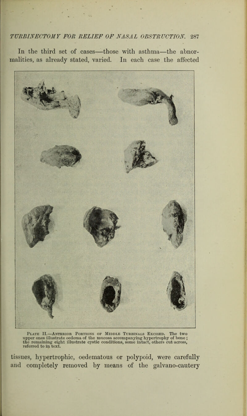 In the third set of cases—those with asthma—the abnor- malities, as already stated, varied. In each case the affected Plate II.—Anterior Portions of Middle Turbinals Excised. The two upper ones illustrate oedema of the mucosa accompanying hypertrophy of bone ; the remaining eight illustrate cystic conditions, some intact, others cut across, referred to in text. tissues, hypertrophic, oedematous or polypoid, were carefully and completely removed by means of the galvano-cautery