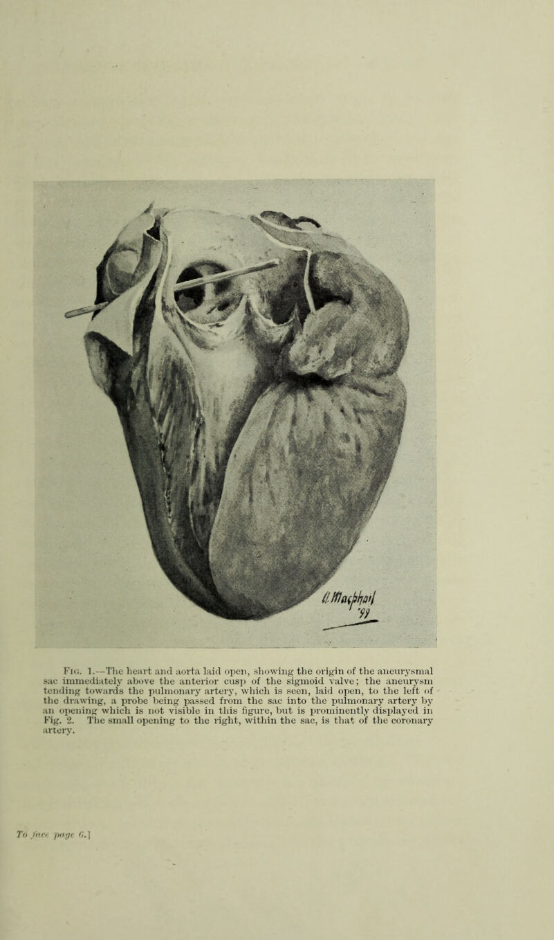 Fig. 1.—The heart and aorta laid open, showing the origin of the aneurysmal sac immediately above the anterior cusp of the sigmoid valve; the aneurysm tending towards the pulmonary artery, which is seen, laid open, to the left of the drawing, a probe being passed from the sac into the pulmonary artery by an opening which is not visible in this figure, but is prominently displayed in Fig. 2. The small opening to the right, within the sac, is that of the coronary artery. To fo.ee j>o,ge 6'.]