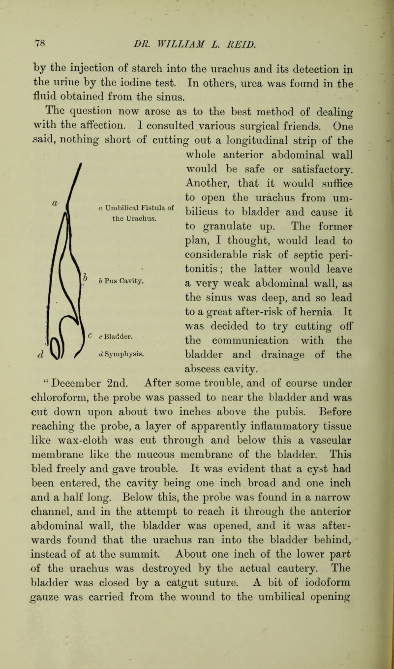 by the injection of starch into the urachus and its detection in the urine by the iodine test. In others, urea was found in the fluid obtained from the sinus. The question now arose as to the best method of dealing with the affection. I consulted various surgical friends. One said, nothing short of cutting out a longitudinal strip of the whole anterior abdominal wall would be safe or satisfactory. Another, that it would suffice to open the urachus from um- bilicus to bladder and cause it to granulate up. The former plan, I thought, would lead to considerable risk of septic peri- tonitis ; the latter would leave a very weak abdominal wall, as the sinus was deep, and so lead to a great after-risk of hernia It was decided to try cutting off the communication with the bladder and drainage of the abscess cavity. “ December 2nd. After some trouble, and of course under •chloroform, the probe was passed to near the bladder and was cut down upon about two inches above the pubis. Before reaching the probe, a layer of apparently inflammatory tissue like wax-cloth was cut through and below this a vascular membrane like the mucous membrane of the bladder. This bled freely and gave trouble. It was evident that a cyst had been entered, the cavity being one inch broad and one inch and a half long. Below this, the probe was found in a narrow channel, and in the attempt to reach it through the anterior abdominal wall, the bladder was opened, and it was after- wards found that the urachus ran into the bladder behind, instead of at the summit. About one inch of the lower part of the urachus was destroyed by the actual cautery. The bladder was closed by a catgut suture. A bit of iodoform .gauze was carried from the wound to the umbilical opening