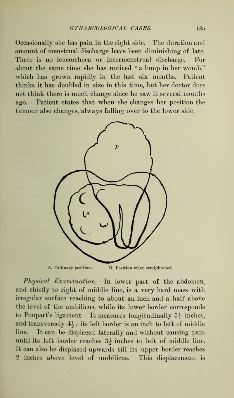 Occasionally she has pain in the right side. The duration and amount of menstrual discharge have been diminishing of late. There is no leucorrhoea or intermenstrual discharge. For about the same time she has noticed “ a lump in her womb,” which has grown rapidly in the last six months. Patient thinks it has doubled in size in this time, but her doctor does not think there is much change since he saw it several months ago. Patient states that when she changes her position the tumour also changes, always falling over to the lower side. Physical Examination.—In lower part of the abdomen, and chiefly to right of middle line, is a very hard mass with irregular surface reaching to about an inch and a half above the level of the umbilicus, while its lower border corresponds to Poupart’s ligament. It measures longitudinally 5J inches, and transversely 4\ ; its left border is an inch to left of middle line. It can be displaced laterally and without causing pain until its left border reaches 3J inches to left of middle line. It can also be displaced upwards till its upper border reaches 2 inches above level of umbilicus. This displacement is