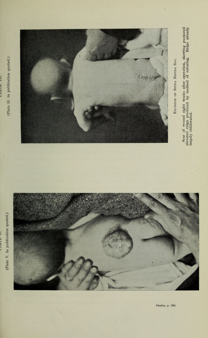 Scar of wound eight weeks after operation, showing puckered elevated ridge produced by method of suturing. Ridge already