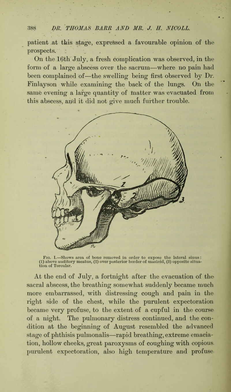 patient at this stage, expressed a favourable opinion of the prospects. : On the 16th July, a fresh complication was observed, in the form of a large abscess over the sacrum—where no pain had been complained of—the swelling being first observed by Dr. Finlayson while examining the back of the lungs. On the same evening a large quantity of matter was evacuated from this abscess, and it did not give mucli further trouble. Fia. I.—Shows area of bone removed in order to expose the lateral sinus: (1) above auditory meatus, (2) over posterior border of mastoid, (3) opposite situa- tion of Torcular. At the end of July, a fortnight after the evacuation of tho sacral abscess, the breathing somewhat suddenly became much more embarrassed, with distressing cough and pain in the right side of the chest, while the purulent expectoration became very profuse, to the extent of a cupful in the course of a night. The pulmonary distress continued, and the con- dition at the beginning of August resembled the advanced stage of phthisis pulmonalis—rapid breathing, extreme emacia- tion, hollow cheeks, great paroxysms of coughing with copious purulent expectoration, also high temperature and profuse