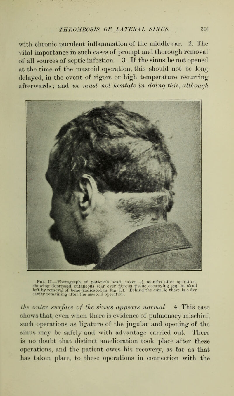 with chronic purulent inflammation of the middle ear. 2. The vital importance in such cases of prompt and thorough removal of all sources of septic infection. 3. If the sinus be not opened at the time of the mastoid operation, this should not be long delayed, in the event of rigors or high temperature recurring afterwards; and we must not hesitate in doing this, although Fig. II.—Photograph of patient’s head, taken months after operation, showing depressed cutaneous scar over fibrous tissue occupying gap in skull left by removal of bone (indicated in Fig. I.). Behind the auricle there is a dry cavity remaining after the mastoid operation. the outer surface of the sinus appears normal. 4. This case shows that, even when there is evidence of pulmonary mischief, such operations as ligature of the jugular and opening of the sinus may be safely and with advantage carried out. There is no doubt that distinct amelioration took place after these operations, and the patient owes his recovery, as far as that has taken place, to these operations in connection with the