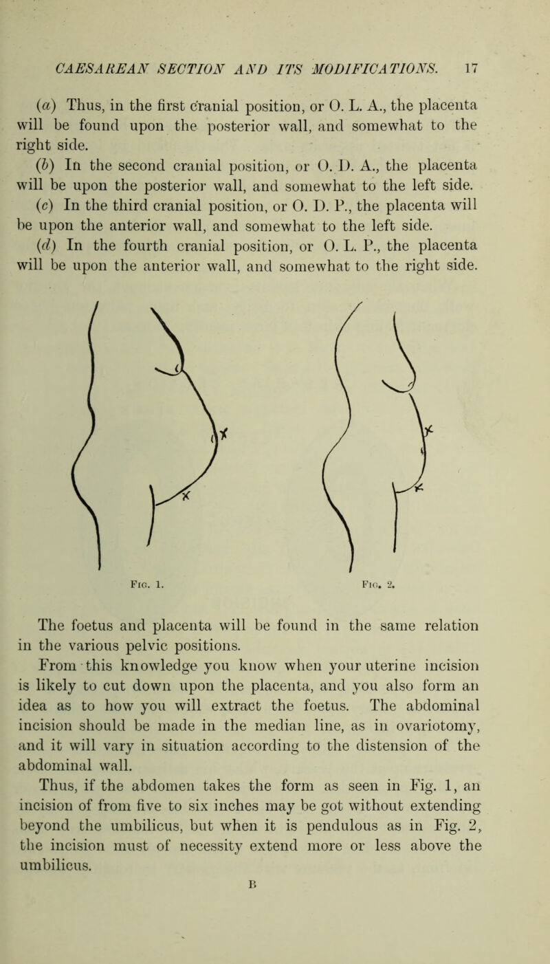 (a) Thus, in the first cranial position, or 0. L. A., the placenta will be found upon the posterior wall, and somewhat to the right side. (b) In the second cranial position, or 0. I). A., the placenta will be upon the posterior wall, and somewhat to the left side. (c) In the third cranial position, or 0. D. R, the placenta will be upon the anterior wall, and somewhat to the left side. (d) In the fourth cranial position, or 0. L. P., the placenta will be upon the anterior wall, and somewhat to the right side. The foetus and placenta will be found in the same relation in the various pelvic positions. From this knowledge you know when your uterine incision is likely to cut down upon the placenta, and you also form an idea as to how you will extract the foetus. The abdominal incision should be made in the median line, as in ovariotomy, and it will vary in situation according to the distension of the abdominal wall. Thus, if the abdomen takes the form as seen in Fig. 1, an incision of from five to six inches may be got without extending beyond the umbilicus, but when it is pendulous as in Fig. 2, the incision must of necessity extend more or less above the umbilicus. Fig. 1. Fig. 2. B