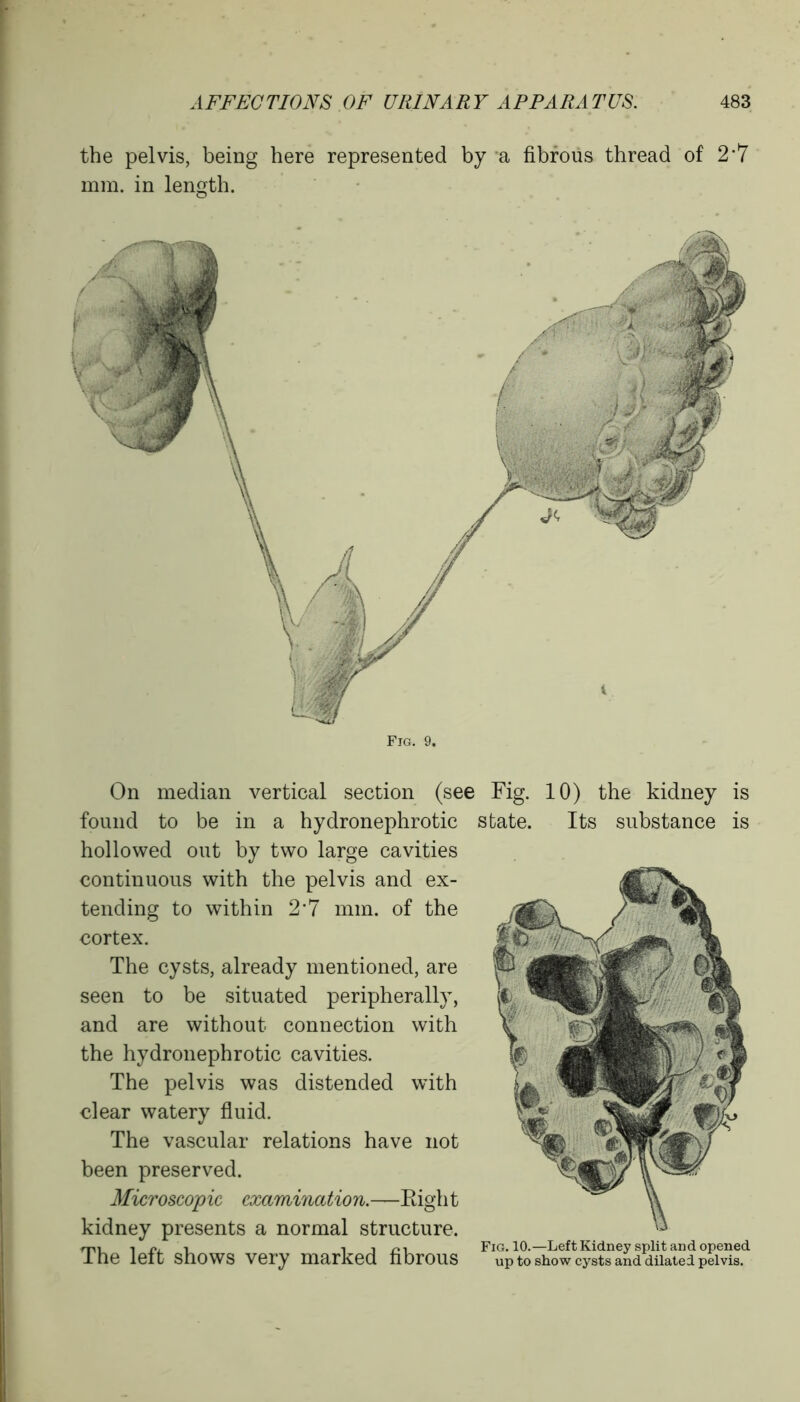 the pelvis, being here represented by a fibrous thread of 2*7 mm. in length. Fig. 9. On median vertical section (see Fig. 10) the kidney is found to be in a hydronephrotic hollowed out by two large cavities continuous with the pelvis and ex- tending to within 2'7 mm. of the cortex. The cysts, already mentioned, are seen to be situated peripherally, and are without connection with the hydronephrotic cavities. The pelvis was distended with clear watery fluid. The vascular relations have not been preserved. Microscopic examination.—Eight kidney presents a normal structure. The left shows very marked fibrous state. Its substance is Fig. 10.—Left Kidney split and opened up to show cysts and dilated pelvis.