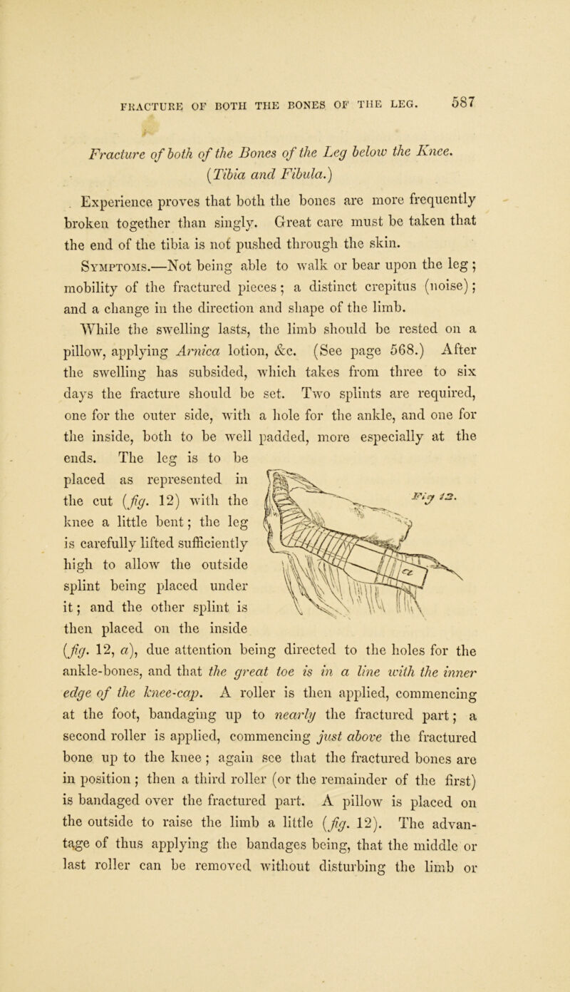 Fracture of both of the Bones of the Leg below the Knee. [Tibia and Fibula.) Experience proves that both the bones are more frequently broken together than singly. Great care must be taken that the end of the tibia is not pushed through the skin. Symptoms.—Not being able to walk or bear upon the leg ; mobility of the fractured pieces; a distinct crepitus (noise); and a change in the direction and shape of the limb. While the swelling lasts, the limb should be rested on a pillow, applying Arnica lotion, &c. (See page 568.) After the swelling has subsided, which takes from three to six days the fracture should be set. Two splints are required, one for the outer side, with a hole for the ankle, and one for the inside, both to be well padded, more especially at the ends. The leg is to be placed as represented in the cut [fig. 12) with the knee a little bent; the leg is carefully lifted sufficiently high to allow the outside splint being placed under it; and the other splint is then placed on the inside [fig. 12, «), due attention being directed to the holes for the ankle-bones, and that the great toe is in a line with the inner edge of the knee-cap. A roller is then applied, commencing at the foot, bandaging up to nearly the fractured part; a second roller is applied, commencing just above the fractured bone up to the knee ; again see that the fractured bones are in position; then a third roller (or the remainder of the first) is bandaged over the fractured part. A pillow is placed on the outside to raise the limb a little [fig. 12). The advan- tage of thus applying the bandages being, that the middle or last roller can be removed without disturbing the limb or