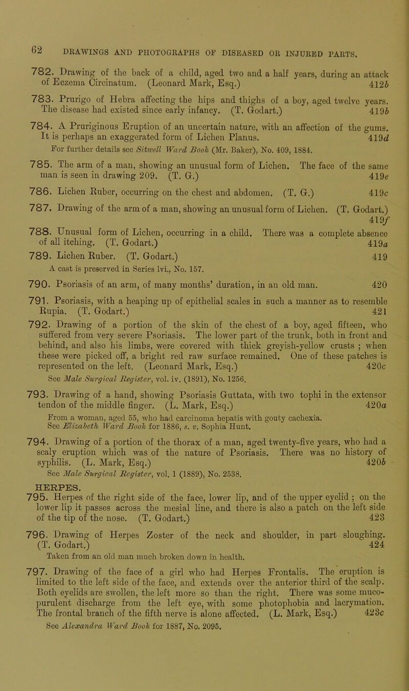 782. Drawing of the back of a child, aged two and a half years, during an attack of Eczema Circinatum. (Leonard Mark, Esq.) 4126 783. Prurigo of Hebra affecting the hips and thighs of a boy, aged twelve years. The disease had existed since early infancy. (T. Godart.) 4196 784. A Pruriginous Eruption of an uncertain nature, with an affection of the gums. It is perhaps an exaggerated form of Lichen Planus. 419d For further details see Sitwell Ward Book (Mr. Baker), No. 409, 1884. 785. The arm of a man, showing an unusual form of Lichen. The face of the same man is seen in drawing 209. (T. G.) 419e 786. Lichen Ruber, occurring on the chest and abdomen. (T. G.) 419c 787. Drawing of the arm of a man, showing an unusual form of Lichen. (T. Godart.) 419/ 788. Unusual form of Lichen, occurring in a child. There was a complete absence of all itching. (T. Godart.) 419a 789. Lichen Ruber. (T. Godart.) 419 A cast is preserved in Series lvi., No. 157. 790. Psoriasis of an arm, of many months’ duration, in an old man. 420 791. Psoriasis, with a heaping up of epithelial scales in such a manner as to resemble Rupia. (T. Godart.) 421 792. Drawing of a portion of the skin of the chest of a boy, aged fifteen, who suffered from very severe Psoriasis. The lower part of the trunk, both in front and behind, and also his limbs, were covered with thick greyish-yellow crusts ; when these were picked off, a bright red raw surface remained. One of these patches is represented on the left. (Leonard Mark, Esq.) 420c See Male Surgical Register, vol. iv. (1891), No. 1256. 793. Drawing of a hand, showing Psoriasis Guttata, with two tophi in the extensor tendon of the middle finger. (L. Mark, Esq.) 420a From a woman, aged 55, who had carcinoma hepatis with gouty cachexia. See Elizabeth Ward Booh for 1886, s. v, Sophia Hunt. 794. Drawing of a portion of the thorax of a man, aged twenty-five years, who had a scaly eruption which was of the nature of Psoriasis. There was no histoiy of syphilis. (L. Mark, Esq.) 4206 See Male Surgical Register, vol. 1 (1889), No. 2538. HERPES. 795. Herpes of the right side of the face, lower lip, and of the upper eyelid ; on the lower lip it passes across the mesial line, and there is also a patch on the left side of the tip of the nose. (T. Godart.) 423 796. Drawing of Herpes Zoster of the neck and shoulder, in part sloughing. (T. Godart.) 424 Taken from an old man much broken down in health. 797. Drawing of the face of a girl who had Herpes Frontalis. The eruption is limited to the left side of the face, and extends over the anterior third of the scalp. Both eyelids are swollen, the left more so than the right. There was some muco- purulent discharge from the left eye, with some photophobia and lacrymation. The frontal branch of the fifth nerve is alone affected. (L. Mark, Esq.) 423c See Alexandra Ward Booh for 1887, No. 2096.
