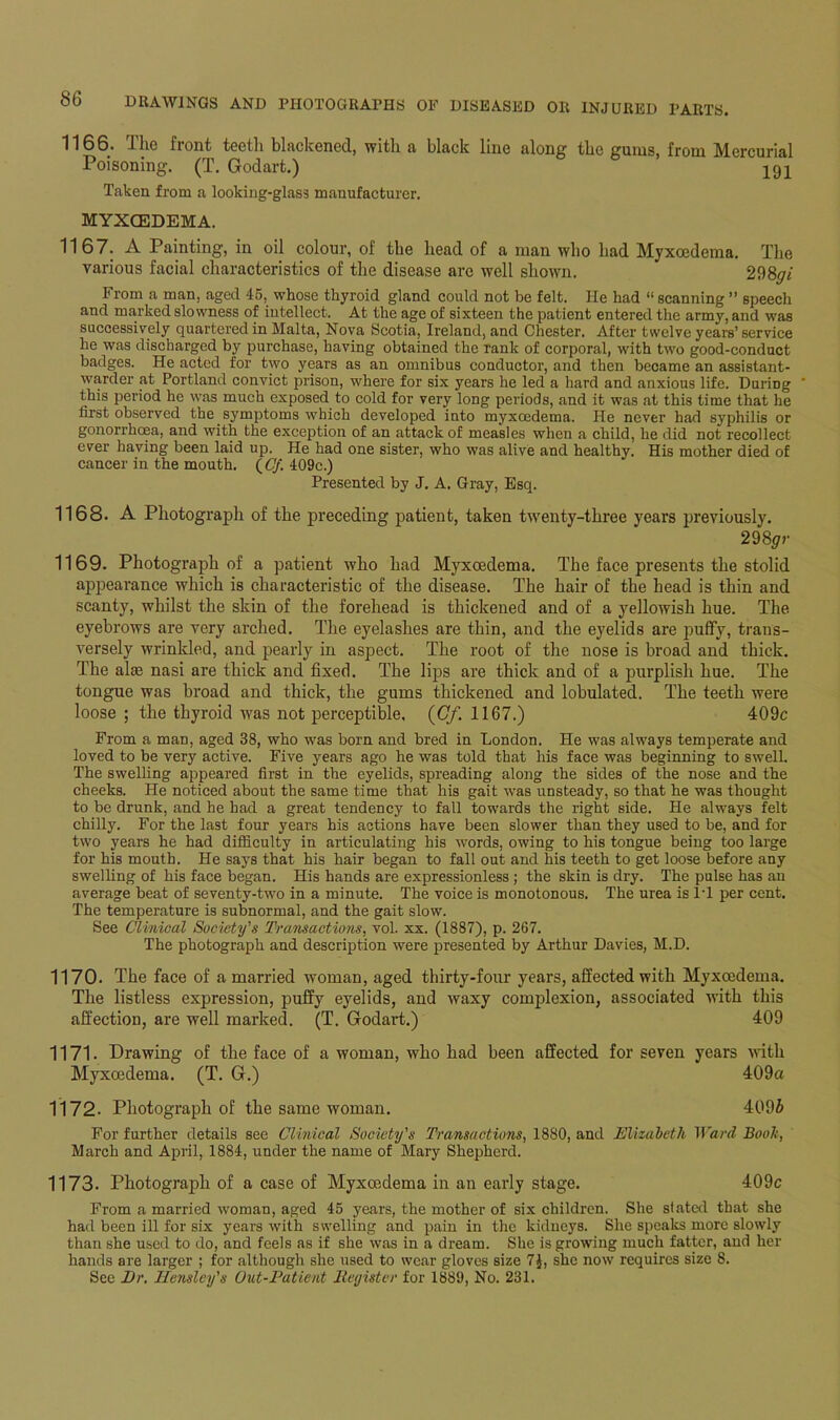 -Llie fiont teeth blackened, with a black line along tbe gum?, from M.ercunal Poisoning. (T. Godart.) ’ 191 Taken from a looking-glass manufacturer. MYXGEDEMA. 1167. A Painting, iii oil colour, of tbe head of a man who bad Myxoedema. The various facial characteristics of the disease are well shown. 298^/ From a man, aged 45, whose thyroid gland could not be felt. He had “ scanning ” speech and marked slowness of intellect. At the age of sixteen the patient entered the army, and was successively quartered in Malta, Nova Scotia, Ireland, and Chester. After twelve years’ service he was discharged by purchase, having obtained the rank of corporal, with two good-conduct badges. He acted for two years as an omnibus conductor, and then became an assistant- warder at Portland convict prison, where for six years he led a hard and anxious life. DuriDg this period he was much exposed to cold for very long periods, and it was at this time that he first observed the symptoms which developed into myxoedema. He never had syphilis or gonorrhoea, and with the exception of an attack of measles when a child, he did not recollect ever having been laid up. He had one sister, who was alive and healthy. His mother died of cancer in the mouth. (Cf. 409c.) Presented by J. A. Gray, Esq. 1168. A Photograph of the preceding patient, taken twenty-three years previously. 298gr 1169. Photograph of a patient who had Myxoedema. The face presents the stolid appearance which is characteristic of the disease. The hair of the head is thin and scanty, whilst the skin of the forehead is thickened and of a yellowish hue. The eyebrows are very arched. The eyelashes are thin, and the eyelids are puffy, trans- versely wrinkled, and pearly in aspect. The root of the nose is broad and thick. The aim nasi are thick and fixed. The lips are thick and of a purplish hue. The tongue was broad and thick, the gums thickened and lobulated. The teeth were loose ; the thyroid was not perceptible, (Cf,1167.) 409c From a man, aged 38, who was born and bred in London. He was always temperate and loved to be very active. Five years ago he was told that his face was beginning to swell. The swelling appeared first in the eyelids, spreading along the sides of the nose and the cheeks. He noticed about the same time that his gait was unsteady, so that he was thought to be drunk, and he had a great tendency to fall towards the right side. He always felt chilly. For the last four years his actions have been slower than they used to be, and for two years he had difficulty in articulating his words, owing to his tongue being too large for his mouth. He says that his hair began to fall out and his teeth to get loose before any swelling of his face began. His hands are expressionless ; the skin is dry. The pulse has an average beat of seventy-two in a minute. The voice is monotonous. The urea is IT per cent. The temperature is subnormal, and the gait slow. See Clinical Society's Transactions, vol. xx. (1887), p. 267. The photograph and description were presented by Arthur Davies, M.D. 1170. The face of a married woman, aged thirty-four years, affected with Myxoedema. Tbe listless expression, puffy eyelids, and waxy complexion, associated with this affection, are well marked. (T. Godart.) 409 1171. Drawing of the face of a woman, who had been affected for seven years with Myxoedema. (T. G.) 409a 1172. Photograph of the same woman. 409£ For further details see Clinical Society's Transactions, 1880, and Elizabeth Ward Booh, March and April, 1884, under the name of Mary Shepherd. 1173. Photograph of a case of Myxoedema in an early stage. 409c From a married woman, aged 45 years, the mother of six children. She stated that she had been ill for six years with swelling and pain in the kidneys. She speaks more slowly than she used to do, and feels as if she was in a dream. She is growing much fatter, and her hands are larger ; for although she used to wear gloves size 7J, she now requires size 8. See Dr, Hensley's Out-Patient Register for 1889, No. 231.