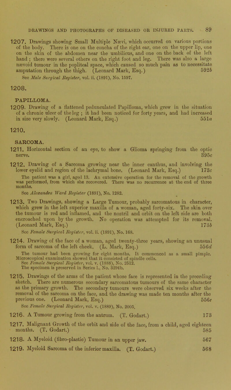 1207. Drawings showing Small Multiple Nsevi, which occurred on various portions of the body. There is one on the concha of the right ear, one on the upper lip, one on the skin of the abdomen near the umbilicus, and one on the back of the left hand ; there were several others on the right foot and leg. There was also a large nrevoid tumour in the popliteal space, which caused so much pain as to necessitate amputation through the thigh. (Leonard Mark, Esq.) 5926 See Male Surgical Register, vol. ii. (1891), No. 1597. 1208. PAPILLOMA. 1209. Drawing of a flattened pedunculated Papilloma, which grew in the situation of a chronic ulcer of the leg ; it had been noticed for forty years, and had increased in size very slowly. (Leonard Mark, Esq.) 551a 1210. SARCOMA. 1211. Horizontal section of an eye, to show a Glioma springing from the optic nerve. 395c 1212. Drawing of a Sarcoma growing near the inner canthus, and involving the lower eyelid and region of the lachrymal bone. (Leonard Mark, Esq.) 173c The patient was a girl, aged 13. An extensive operation for the removal of the growth was performed, from which she recovered. There was no recurrence at the end of three months. See Alexandra Ward Register (1891), No. 1282. 1213. Two Drawings, showing a Large Tumour, probably sarcomatous in character, which grew in the left superior maxilla of a woman, aged forty-six. The skin over the tumour is red and inflamed, and the nostril and orbit on the left side aro both encroached upon by the growth. No operation was attempted for its removal. (Leonard Mark, Esq.) 1736 See Female Surgical Register, vol. ii. (1891), No. 168. 1214. Drawing of the face of a woman, aged twenty-three years, showing an unusual form of sarcoma of the left cheek. (L. Mark, Esq.) 55Gd The tumour had been growing for eight months. It commenced as a small pimple. Microscopical examination showed that it consisted of spindle cells. See Female Surgical Register, vol. v. (1888), No. 2512. The specimen is preserved in Series 1., No. 3291b. 1215. Drawings of the arms of the patient whose face is represented in the preceding sketch. There are numerous secondary sarcomatous tumours of the same character as the primary growth. The secondary tumours were observed six weeks after the removal of the sarcoma on the face, and the drawing was made ten months after the previous one. (Leonard Mark, Esq.) 556e See Female Surgical Register, vol. v. (1889), No. 2005. 1216. A Tumour growing from the antrum. (T. Godart.) 173 1217. Malignant Growth of the orbit and side of the face, from a child, aged eighteen months. (T. Godart.)  585 1218. A Myeloid (fibro-plastic) Tumour in an upper jaw. 567 1219. Myeloid Sarcoma of the inferior maxilla. (T. Godart.) 568