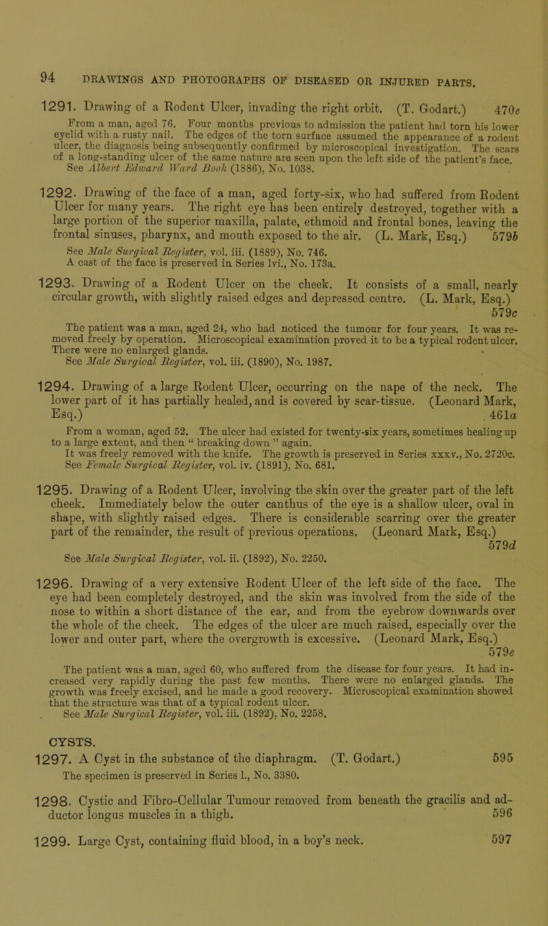 1291. Drawing of a Rodent Ulcer, invading the right orbit. (T. Godart.) 470« Prom a man, aged 76. Four months previous to admission the patient had torn his lower eyelid with a rusty nail. The edges of the torn surface assumed the appearance of a rodent ulcer, the diagnosis being subsequently confirmed by microscopical investigation. The scars of a long-standing ulcer of the same nature are seen upon the left side of the patient’s face. See Albert Edward Ward Booh (1886), No. 1038. 1292. Drawing of the face of a man, aged forty-six, who had suffered from Rodent Ulcer for many years. The right eye lias been entirely destroyed, together with a large portion of the superior maxilla, palate, ethmoid and frontal bones, leaving the frontal sinuses, pharynx, and mouth exposed to the air. (L. Mark, Esq.) 5796 See Male Surgical Register, vol. iii. (1889), No. 746. A cast of the face is preserved in Series lvi., No. 173a. 1293. Drawing of a Rodent Ulcer on the cheek. It consists of a small, nearly circular growth, with slightly raised edges and depressed centre. (L. Mark, Esq.) 579c The patient was a man, aged 24, who had noticed the tumour for four years. It was re- moved freely by operation. Microscopical examination proved it to be a typical rodent ulcer. There were no enlarged glands. See Male Surgical Register, vol. iii. (1890), No. 1987. 1294. Drawing of a large Rodent Ulcer, occurring on the nape of the neck. The lower part of it has partially healed, and is covered by sear-tissue. (Leonard Mark, Esq.) 461a From a woman, aged 52. The ulcer had existed for twenty-six years, sometimes healing up to a large extent, and then “ breaking down ” again. It was freely removed with the knife. The growth is preserved in Series xxxv., No. 2720c. See Female Surgical Register, vol. iv. (1891), No. 681. 1295. Drawing of a Rodent Ulcer, involving the skin over the greater part of the left cheek. Immediately below the outer canthus of the eye is a shallow ulcer, oval in shape, with slightly raised edges. There is considerable scarring over the greater part of the remainder, the result of previous operations. (Leonard Mark, Esq.) 579d See Male Surgical Register, vol. ii. (1892), No. 2250. 1296. Drawing of a very extensive Rodent Ulcer of the left side of the face. The eye had been completely destroyed, and the skin was involved from the side of the nose to within a short distance of the ear, and from the eyebrow downwards over the whole of the cheek. The edges of the ulcer are much raised, especially over the lower and outer part, where the overgrowth is excessive. (Leonard Mark, Esq.) 579e The patient was a man, aged 60, who suffered from the disease for four years. It had in- creased very rapidly during the past few months. There were no enlarged glands. The growth was freely excised, and he made a good recovery. Microscopical examination showed that the structure was that of a typical rodent ulcer. See Male Surgical Register, vol. iii. (1892), No. 2258, CYSTS. 1297. A Cyst in the substance of the diaphragm. (T. Godart.) 595 The specimen is preserved in Series 1., No. 3380. 1298. Cystic and Fibro-Cellular Tumour removed from beneath the gracilis and ad- ductor longus muscles in a thigh. 596 1299. Large Cyst, containing fluid blood, in a boy’s neck. 597