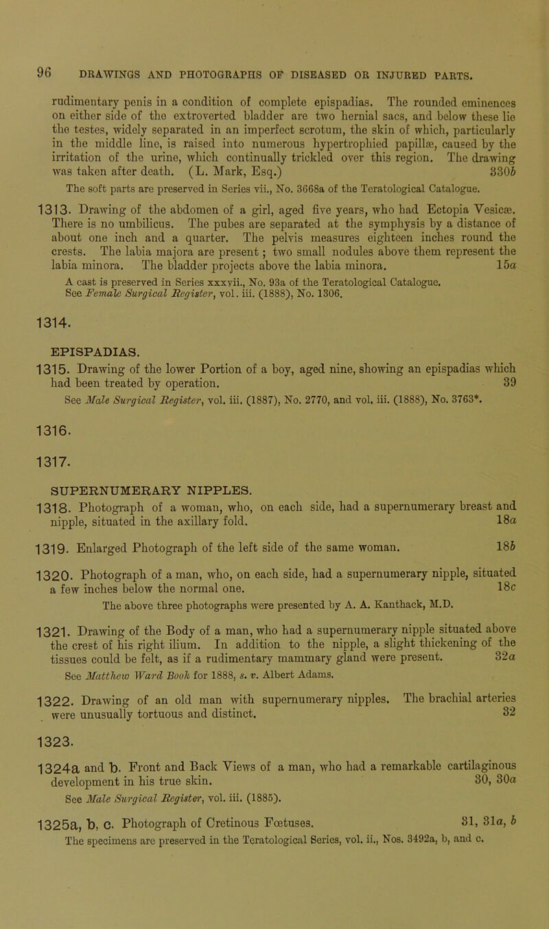 rudimentary penis in a condition of complete epispadias. The rounded eminences on either side of tho extroverted bladder are two hernial sacs, and below these lie the testes, widely separated in an imperfect scrotum, the skin of which, particularly in the middle line, is raised into numerous hypertrophied papilla}, caused by the irritation of the urine, which continually trickled over this region. The drawing was taken after death. (L. Mark, Esq.) 3306 The soft parts are preserved in Series vii., No. 3668a of the Teratological Catalogue. 1313. Drawing of the abdomen of a girl, aged five years, who had Ectopia Yesicae. There is no umbilicus. The pubes are separated at the symphysis by a distance of about one inch and a quarter. The pelvis measures eighteen inches round the crests. The labia majora are present; two small nodules above them represent the labia minora. The bladder projects above the labia minora. 15a A cast is preserved in Series xxxvii., No. 93a of the Teratological Catalogue. See Female Surgical Register, vol. iii. (1888), No. 1306. 1314. EPISPADIAS. 1315. Drawing of the lower Portion of a boy, aged nine, showing an epispadias which had been treated by operation. 39 See Male Surgical Register, vol. iii. (1887), No. 2770, and vol. iii. (1888), No. 3763*. 1316. 1317. SUPERNUMERARY NIPPLES. 1318. Photograph of a woman, who, on each side, had a supernumerary breast and nipple, situated in the axillary fold. 18a 1319. Enlarged Photograph of the left side of the same woman. 186 1320. Photograph of a man, who, on each side, had a supernumerary nipple, situated a few inches below the normal one. 18c The above three photographs were presented by A. A. Kanthack, M.D. 1321. Drawing of the Body of a man, who had a supernumerary nipple situated above the crest of his right ilium. In addition to the nipple, a slight thickening of the tissues could be felt, as if a rudimentary mammary gland were present. 32a See Matthew Ward Booh for 1888, s. v. Albert Adams. 1322. Drawing of an old man with supernumerary nipples. The brachial arteries were unusually tortuous and distinct. 32 1323. 1324a and b. Front and Back Views of a man, who had a remarkable cartilaginous development in his true skin. 30, 30a See Male Surgical Register, vol. iii. (1885). 1325a, b, c. Photograph of Cretinous Foetuses. 31, 31a, b The specimens are preserved in the Teratological Series, vol. ii., Nos. 3492a, b, and c.
