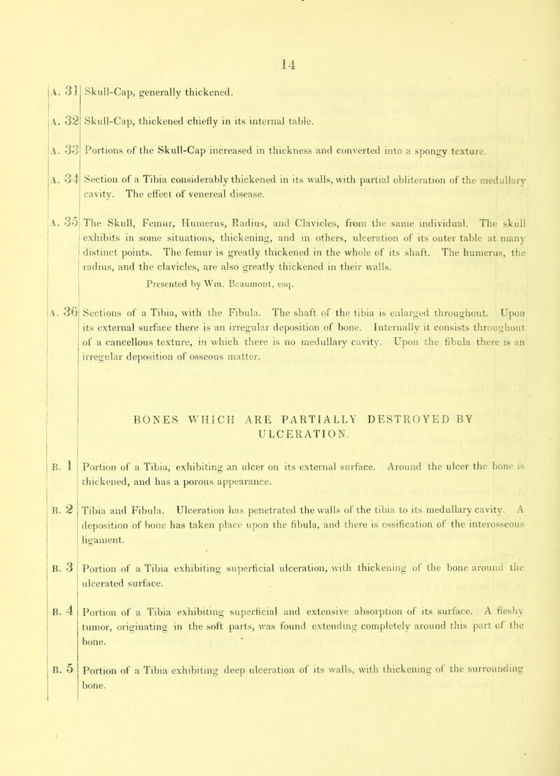 a. 33 a. 32 a. 33 a. 34 a. 35 i I a. 361 I B. 3 j B. 2 B. 3 ' B. 4 I B. 5 Skull-Cap, generally thickened. Skull-Cap, thickened chiefly in its internal table. Portions of the Skull-Cap increased in thickness and converted into a spongy texture. Section of a Tibia considerably thickened in its walls, with partial obliteration of the medullary cavity. The effect of venereal disease. The Skull, Femur, Humerus, Radius, and Clavicles, from the same individual. The skull exhibits in some situations, thickening, and in others, ulceration of its outer table at many distinct points. The femur is greatly thickened in the whole of its shaft. The humerus, tire radius, and the clavicles, are also greatly thickened in their walls. Presented by Wm. Beaumont, esq. Sections of a Tibia, with the Fibula. The shaft of the tibia is enlarged throughout. Upon its external surface there is an irregular deposition of bone. Internally it consists throughout of a cancellous texture, in which there is no medullary cavity. Upon the fibula there is an irregular deposition of osseous matter. BONES WHICH ARE PARTIALLY DESTROYED BY ULCERATION. Portion of a Tibia, exhibiting an ulcer on its external surface. Around the ulcer the bone is thickened, and has a porous appearance. Tibia and Fibula. Ulceration has penetrated the walls of the tibia to its medullary cavity. A deposition of bone has taken place upon the fibula, and there is ossification of the interosseous ligament. Portion of a Tibia exhibiting superficial ulceration, with thickening of the bone around the ulcerated surface. Portion of a Tibia exhibiting superficial and extensive absorption of its surface. A fleshy tumor, originating in the soft parts, was found extending completely around this part of the bone. Portion of a Tibia exhibiting deep ulceration of its walls, with thickening of the surrounding bone.