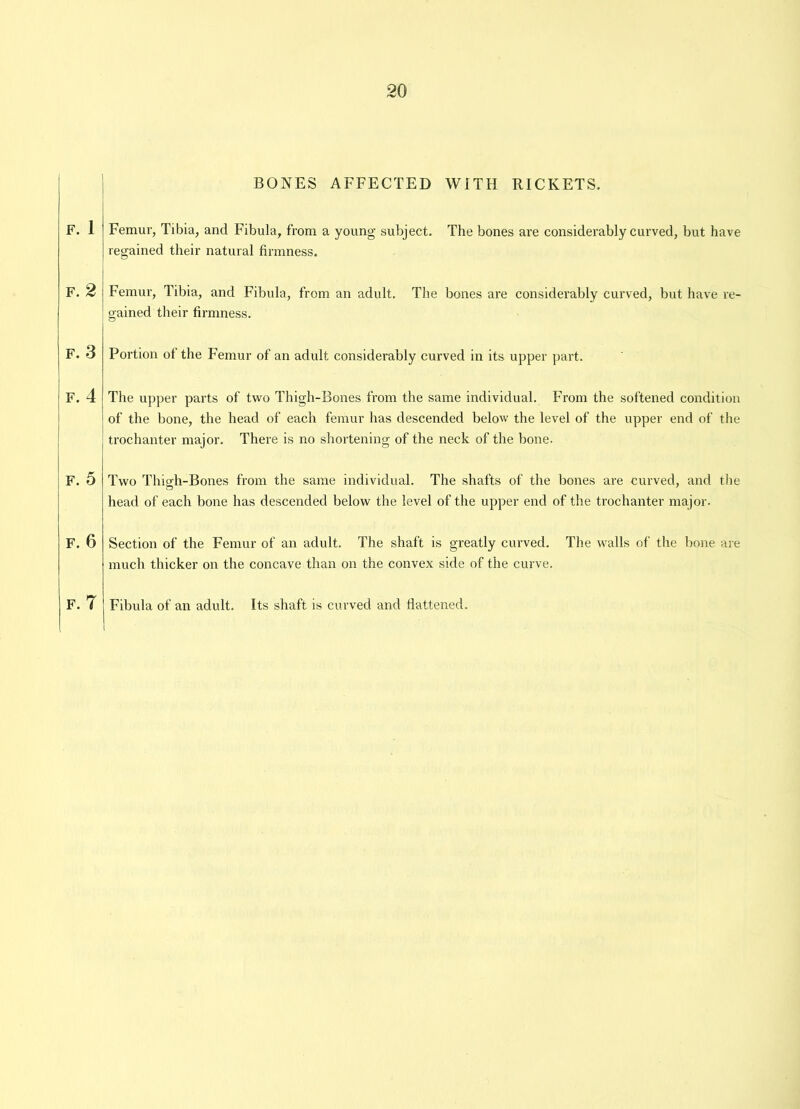F. 1 F. 2 F. 3 F. 4 F. 5 F. 6 F. 7 BONES AFFECTED WITH RICKETS. Femur, Tibia, and Fibula, from a young subject. The bones are considerably curved, but have regained their natural firmness. Femur, Tibia, and Fibula, from an adult. The bones are considerably curved, but have re- gained their firmness. Portion of the Femur of an adult considerably curved in its upper part. The upper parts of two Thigh-Bones from the same individual. From the softened condition of the bone, the head of each femur has descended below the level of the upper end of the | trochanter major. There is no shortening of the neck of the bone. Two Thigh-Bones from the same individual. The shafts of the bones are curved, and the head of each bone has descended below the level of the upper end of the trochanter major. Section of the Femur of an adult. The shaft is greatly curved. The walls of the bone are much thicker on the concave than on the convex side of the curve. Fibula of an adult. Its shaft is curved and flattened.