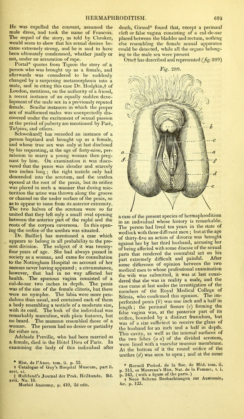 He was expelled the convent, assumed the male dress, and took the name of Francois. The sequel of the story, as told by Chroker, would seem to shew that his sexual desires be- came extremely strong, and he is said to have been ultimately condemned, whether justly or not, under an accusation of rape. Portal* quotes from Tigeon the story of a person who was brought up as a female, and afterwards was considered to be suddenly changed by a surprising metamorphosis into a male, and in citing this case Dr. Hodgkin,f of London, mentions, on the authority of a friend, a recent instance of an equally sudden deve- lopment of the male sex in a previously reputed female. Similar instances in which the proper sex of malformed males was unexpectedly dis- covered under the excitement of sexual passion at the period of puberty are mentioned by Parfe, Tulpius, and others. Schweikardj; has recorded an instance of a person baptized and brought up as a female, and whose true sex was only at last disclosed by his requesting, at the age of forty-nine, per- mission to marry a young woman then preg- nant by him. On examination it was disco- vered that the penis was slender and scarcely two inches long ; the right testicle only had descended into the scrotum, and the urethra opened at the root of the penis, but its orifice was placed in such a manner that during mic- turition the urine was thrown along the groove or channel on the under surface of the penis, so as to appear to issue from its anterior extremity. The two halves of the scrotum were so far united that they left only a small oval opening between the anterior part of the raphe and the roots of the corpora cavernosa. In this open- ing the orifice of the urethra was situated. Dr. Baillie § has mentioned a case which appears to belong in all probability to the pre- sent division. The subject of it was twenty- four years of age. She had always passed in society as a woman, and came for consultation to the Nottingham Hospital on account of her menses never having appeared ; a circumstance, however, that had in no way affected her health. The spurious vagina consisted of a cul-de-sac two inches in depth. The penis was of the size of the female clitoris, but there were no nymphae. The labia were more pen- dulous than usual, and contained each of them a body resembling a testicle of a moderate size, with its cord. The look of the individual was remarkably masculine, with plain features, but no beard. The mammae resembled those of a woman. The person had no desire or partiality for either sex. Adelaide Preville, who had been married as a female, died in the Hotel Dieu of Paris. In examining the body of this individual after * Hist, de l’Anat. tom. ii. p. 52. t Catalogue of Guy’s Hospital Museum, partii. sect. xi. t Hufeland’s Journal der Prak. Heilkunde. Bd. xvii. No. 18. Morbid Anatomy, p. 410, 2d edit. death, Giraud* found that, except a perinaeal cleft or false vagina consisting of a cul-de-sac placed between the bladder and rectum, nothing else resembling the female sexual apparatus could be detected, while all the organs belong- ing to the male sex were present Ottof has described and represented (fig.289) Fig. 289. a case of the present species of hermaphroditism in an individual whose history is remarkable. The person had lived ten years in the state of wedlock with three different men ; but at the age of thirty-five an action of divorce was brought against her by her third husband, accusing her of being affected with some disease of the sexual parts that rendered the connubial act on his part extremely difficult and painful. After some difference of opinion between the two medical men to whose professional examination the wife was submitted, it was at last consi- dered that she was in reality a male, and the case came at last under the investigation of the members of the Royal Medical College of Silesia, who confirmed this opinion. The im- perforated penis (6) was one inch and a half in length ; the perinaeal fissure (e) forming the false vagina was, at the posterior part of its orifice, bounded by a distinct framulum, but was of a size sufficient to receive the glans of the husband for an inch and a half in depth. This cavity, as well as the internal surfaces of the two lobes (a a) of the divided scrotum, were lined with a vascular mucous membrane. At the bottom of it the round orifice of the urethra (d) was seen to open ; and at the same * Recueil Period, de la Soc. de Med. tom. ii. p. 315, or Moureau’s Hist. Nat. de la Femme, t. i. p. 243, (with a figure of the parts.) f Neue Scltcnc Beobachtungen zur Anatomic, &c. p. 123.