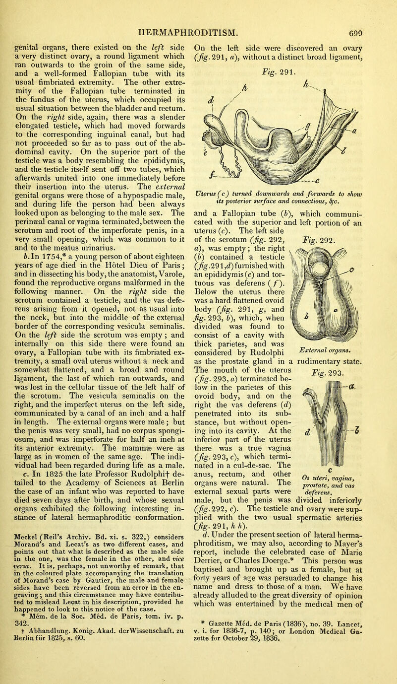 genital organs, there existed on the left side a very distinct ovary, a round ligament which ran outwards to the groin of the same side, and a well-formed Fallopian tube with its usual fimbriated extremity. The other extre- mity of the Fallopian tube terminated in the fundus of the uterus, which occupied its usual situation between the bladder and rectum. On the right side, again, there was a slender elongated testicle, which had moved forwards to the corresponding inguinal canal, but had not proceeded so far as to pass out of the ab- dominal cavity. On the superior part of the testicle was a body resembling the epididymis, and the testicle itself sent off two tubes, which afterwards united into one immediately before their insertion into the uterus. The external genital organs were those of a hypospadic male, and during life the person had been always looked upon as belonging to the male sex. The peri nasal canal or vagina terminated,between the scrotum and root of the imperforate penis, in a very small opening, which was common to it and to the meatus urinarius. b. In 1754,* a young person of about eighteen years of age died in the Hotel Dieu of Paris; and in dissecting his body, the anatomist, Varole, found the reproductive organs malformed in the following manner. On the right side the scrotum contained a testicle, and the vas defe- rens arising from it opened, not as usual into the neck, but into the middle of the external border of the corresponding vesicula seminalis. On the left side the scrotum was empty ; and internally on this side there were found an ovary, a Fallopian tube with its fimbriated ex- tremity, a small oval uterus without a neck and somewhat flattened, and a broad and round ligament, the last of which ran outwards, and was lost in the cellular tissue of the left half of the scrotum. The vesicula seminalis on the right, and the imperfect uterus on the left side, communicated by a canal of an inch and a half in length. The external organs were male; but the penis was very small, had no corpus spongi- osum, and was imperforate for half an inch at its anterior extremity. The mammae were as large as in women of the same age. The indi- vidual had been regarded during life as a male. c. In 1825 the late Professor Rudolphif de- tailed to the Academy of Sciences at Berlin the case of an infant who was reported to have died seven days after birth, and whose sexual organs exhibited the following interesting in- stance of lateral hermaphroditic conformation. Meckel (Reil’s Archiv. Bd. xi. s. 322,) considers Morand’s and Lecat’s as two different cases, and points out that what is described as the male side in the one, was the female in the other, and vice versa. It is, perhaps, not unworthy of remark, that in the coloured plate accompanying the translation of Morand’s case by Gautier, the male and female sides have been reversed from an error in the en- graving ; and this circumstance may have contribu- ted to mislead Lecat in his description, provided he happened to look to this notice of the case. * Mem. de la Soc. Med. de Paris, tom. iv. p. 342. f Abhandlnng. Konig. Akad. derWissenschaft. zu Berlin fur 1825, s. 60. On the left side were discovered an ovary (fig. 291, a), without a distinct broad ligament, Fig. 291. Uterus (c) turned downwards and forwards to show its posterior surface and connections, tyc. and a Fallopian tube (b), which communi- cated with the superior and left portion of an uterus (c). The left side of the scrotum (fig. 292, Fig. 292. a), was empty; the right (6) contained a testicle (fig.291 ,d) furnished with an epididymis (e) and tor- tuous vas deferens (./’). Below the uterus there was a hard flattened ovoid body (fig. 291, g, and fig. 293, b), which, when divided was found to consist of a cavity with thick parietes, and was considered by Rudolphi External organs. as the prostate gland in a rudimentary state. The mouth of the uterus (fig. 293, a) terminated be- low in the parietes of this ovoid body, and on the right the vas deferens (d) penetrated into its sub- stance, but without open- ing into its cavity. At the inferior part of the uterus there was a true vagina (fig. 293, c), which termi- nated in a cul-de-sac. The anus, rectum, and other organs were natural. The external sexual parts were male, but the penis was divided inferiorly (fig. 292, c). The testicle and ovary were sup- plied with the two usual spermatic arteries (fig. 291, A h). d. Under the present section of lateral herma- phroditism, we may also, according to Mayer’s report, include the celebrated case of Marie Derrier, or Charles Doerge.* This person was baptised and brought up as a female, but at forty years of age was persuaded to change his name and dress to those of a man. We have already alluded to the great diversity of opinion which was entertained by the medical men of * GazetteMed.de Paris (1836), no. 39. Lancet, v. i. for 1836-7, p. 140; or London Medical Ga- zette for October 29, 1836. Fig. 293. Os uteri, vagina, prostate, and vas deferens.