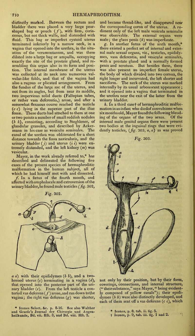 distinctly marked. Between the rectum and bladder there was placed a very large pear- shaped bag or pouch (./'), with firm, coria- ceous, but not thick walls, and distended with fluid. This bag or imperfect cystoid uterus terminated inferiorly by a narrow neck, in a vagina that opened into the urethra, in the situ- ation of the verumontanum, and was there dilated into a large bag or ampulla, occupying exactly the site of the prostate gland, and re- sembling this organ also in its form and posi- tion. The internal membrane of the uterus was collected at its neck into numerous val- vular-like folds, and that of the vagina had also a rugous or plicated arrangement. From the fundus of the large sac of the uterus, and not from its angles, but from near its middle, two impervious solid ducts (Fallopian tubes, or rather vasa defcrentia,) arose, and after a somewhat flexuous course reached the testicle (c c) lying in the superior part of the iliac fossae. These ducts had attached to them at one or two points a number of small reddish nodules (b b), consisting, according to Steghlener, of glandular granules, and described by Acker- mann in his case as vesiculre seminales. The canal of the urethra was obliterated for a short distance towards the fossa navicularis, and the urinary bladder (j) and uterus (i i) were ex- tremely distended, and the left kidney (»i) was vesicular. Mayer, in the work already referred to,* has described and delineated the following five cases of the present species of hermaphroditic malformation in the human subject, all of which he had himself met with and dissected. /• a foetus of the fourth month, and affected with omphalocele and extroversion of the urinary bladder, he found male testicles (fig. 302, Fig. 302. that opened into the posterior part of the uri- nary bladder (e). From the left testicle a con- torted vas deferens (_/) arose,and ran down to the vagina; the right vas deferens (g) was shorter, * leones Select. &c. p. 8-16. See also Walther and Graefe’s Journal der Chirurgie und Augen- heilkunde, Bd. vii. Hft. 3, and Bd. viii. Hft. 2. and became thread-like, and disappeared near the corresponding cornu of the uterus. A ru- diment only of the left male vesicula seminalis was observable. The external organs were male; the glans penis (b) was imperforate. g. In another foetus of the sixth month,* there existed a perfect set of internal and exter- nal male sexual organs, viz., testicles, epididy- mes, vasa deferentia, and vesicul* seminales, with a prostate gland and a normally formed penis and scrotum. But besides these, there was also present an imperfect female uterus, the body of which divided into two cornua, the right longer and incurvated, the left shorter and sacciform. The neck of the uterus was marked internally by its usual arborescent appearance ; and it opened into a vagina that terminated in the urethra near the exit of the latter from the urinary bladder. A. In a third casef of hermaphroditic malfor- mation in an infant who diedof convulsions when six months old, Mayer found the following blend- ing of the organs of the two sexes. Of the internal male genital organs there were present two bodies at the inguinal rings that were evi- dently testicles, (Jig. 303, a, «) as was proved Fig. 303. not only by their position, but by their form, coverings, connections, and internal structure, (“ their substance,” says Mayer, “ being evident- ly composed of yellow canals”); their epidi- dymes (b b) were also distinctly developed, and each of them sent off a vas deferens (c c), which * leones, p. 8. tab. ii. fig. 5. f leones, p. 9, tab. iii. fig. 1 and 2. “i