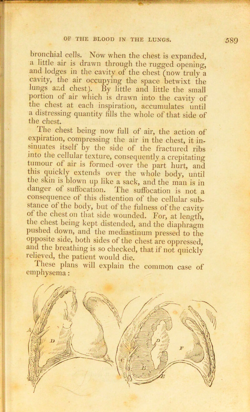 bronchial cells. Now when the chest is expanded, a little air is drawn through the rugged opening, and lodges in the cavity of the chest (now truly a cavity, the air occupying the space betwixt the lungs and chestj. By little and little the small portion of air which is drawn into the cavity of the chest at each inspiration, accumulates until a distressing quantity fills the whole of that side of the chest. The chest being now full of air, the action of expiration, compressing the air in the chest, it in- sinuates itself by the side of the fractured ribs into the cellular texture, consequently a crepitating tumour of air is formed -over the part hurt, and this quickly extends over the whole body, until the skin is blown up like a sack, and the man is in danger of suffocation. The suffocation is not a consequence of this distention of the cellular sub- stance of the body, but of the f ulness of the cavity of the chest on that side wounded. Tor, at length, the chest being kept distended, and the diaphragm pushed down, and the mediastinum pressed to the opposite side, both sides of the chest are oppressed, and the breathing is so checked, that if not quickly relieved, the patient would die. I hese plans will explain the common case of emphysema: