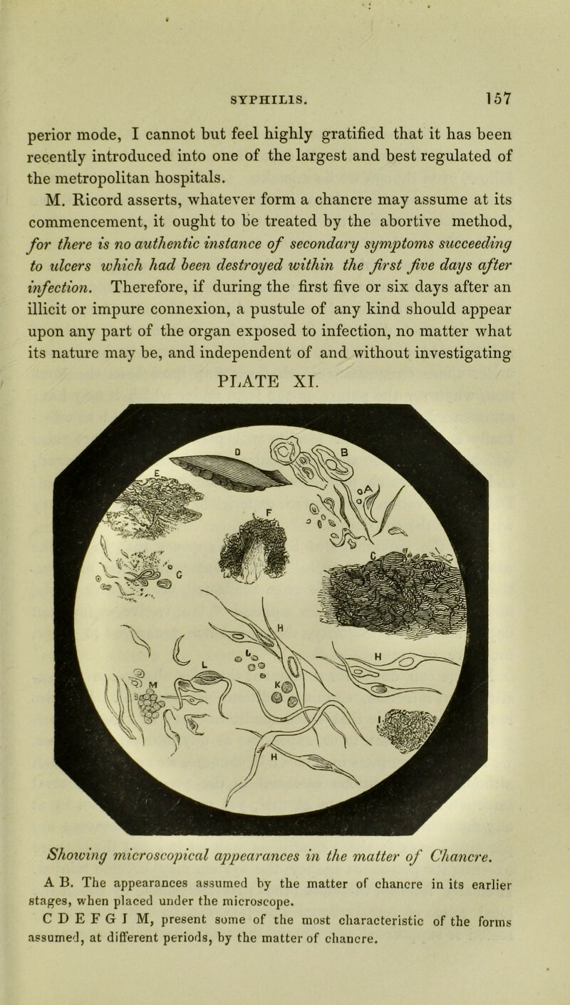 perior mode, I cannot but feel highly gratified that it has been recently introduced into one of the largest and best regulated of the metropolitan hospitals. M. Ricord asserts, whatever form a chancre may assume at its commencement, it ought to be treated by the abortive method, for there is no authentic instance of secondary symptoms succeeding to ulcers which had been destroyed within the first five days after infection. Therefore, if during the first five or six days after an illicit or impure connexion, a pustule of any kind should appear upon any part of the organ exposed to infection, no matter what its nature may be, and independent of and without investigating PLATE XI. Showing microscopical appearances in the matter of Chancre. A B. The appearances assumed by the matter of chancre in its earlier stages, when placed under the microscope. C D E F G J M, present some of the most characteristic of the forms assumed, at different periods, by the matter of chancre.