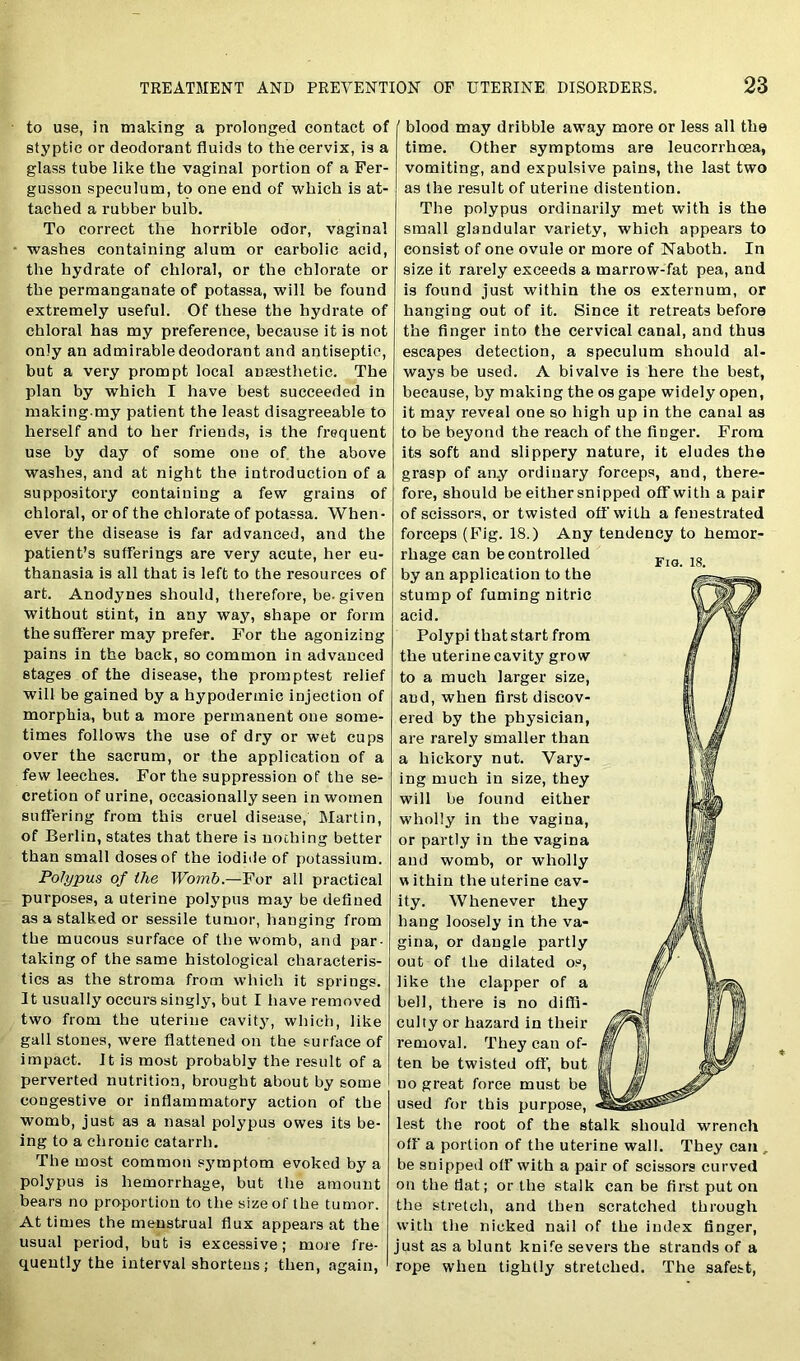 to use, in making a prolonged contact of styptic or deodorant fluids to the cervix, is a glass tube like the vaginal portion of a Fer- gusson speculum, to one end of which is at- tached a rubber bulb. To correct the horrible odor, vagina! washes containing alum or carbolic acid, the hydrate of chloral, or the chlorate or the permanganate of potassa, will be found extremely useful. Of these the hydrate of chloral has my preference, because it is not only an admirable deodorant and antiseptic, but a very prompt local anaesthetic. The plan by which I have best succeeded in making.my patient the least disagreeable to herself and to her friends, is the frequent use by day of some one of the above washes, and at night the introduction of a suppository containing a few grains of chloral, or of the chlorate of potassa. When- ever the disease is far advanced, and the patient’s sufferings are very acute, her eu- thanasia is all that is left to the resources of art. Anodynes should, therefore, be-given without stint, in any way, shape or form the sufferer may prefer. For the agonizing pains in the back, so common in advanced stages of the disease, the promptest relief will be gained by a hypodermic injection of morphia, but a more permanent one some- times follows the use of dry or wet cups over the sacrum, or the application of a few leeches. For the suppression of the se- cretion of urine, occasionally seen in women suffering from this cruel disease, Martin, of Berlin, states that there is nothing better than small doses of the iodide of potassium. Polypus of the Womb.—Yor all practical purposes, a uterine polypus may be defined as a stalked or sessile tumor, hanging from the mucous surface of the womb, and par- taking of the same histological characteris- tics as the stroma from which it springs. It usually occurs singly, but I have removed two from the uterine cavity, which, like gall stones, were flattened on the surface of impact. It is most probably the result of a perverted nutrition, brought about by some congestive or inflammatory action of the womb, just as a nasal polypus owes its be- ing to a chronic catarrh. The most common symptom evoked by a polypus is hemorrhage, but the amount bears no proportion to the size of the tumor. At times the menstrual flux appears at the usual period, but is excessive; more fre- quently the interval shortens; then, again, ' blood may dribble away more or less all the time. Other symptoms are leucorrhoea, vomiting, and expulsive pains, the last two as the result of uterine distention. The polypus ordinarily met with is the small glandular variety, which appears to consist of one ovule or more of Naboth. In size it rarely exceeds a marrow-fat pea, and is found just within the os externum, or hanging out of it. Since it retreats before the finger into the cervical canal, and thus escapes detection, a speculum should al- ways be used. A bivalve is here the best, because, by making the os gape widely open, it may reveal one so high up in the canal as to be beyond the reach of the finger. From its soft and slippery nature, it eludes the grasp of an.y ordinary forceps, and, there- fore, should be either snipped off with a pair of scissors, or twisted off with a fenestrated forceps (Fig. 18.) Any tendency to hemor- rhage can be controlled by an application to the stump of fuming nitric acid. Polypi that start from the uterine cavity grow to a much larger size, and, when first discov- ered by the physician, are rarely smaller than a hickory nut. Vary- ing much in size, they will be found either wholly in the vagina, or partly in the vagina and womb, or wholly w ithin the uterine cav- ity. Whenever they hang loosely in the va- gina, or dangle partly out of the dilated os, like the clapper of a bell, there is no diffi- culty or hazard in their removal. They can of- ten be twisted off, but uo great force must be used for this purpose, lest the root of the stalk should wrench off a portion of the uterine wall. They can , be snipped off with a pair of scissors curved on the fiat; or the stalk can be first put on the stretch, and then scratched through with the nicked nail of the index finger, just as a blunt knife severs the strands of a rope when tightly stretched. The safest,