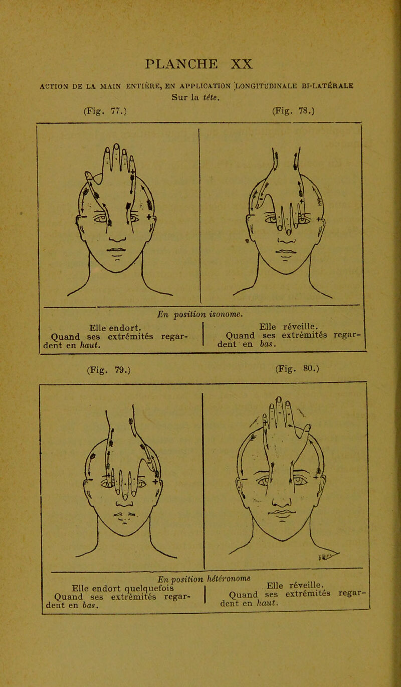 ACTION DE LA MAIN ENTIÈRE, EN APPLICATION LONGITUDINALE BI-LATÉRALE Sur la tétc. (Fig. 77.) (Fig. 78.) En positio Elle endort. Quand ses extrémités regar- dent en haut. n isonomc. Elle réveille. Quand ses extrémités regar- dent en bas.