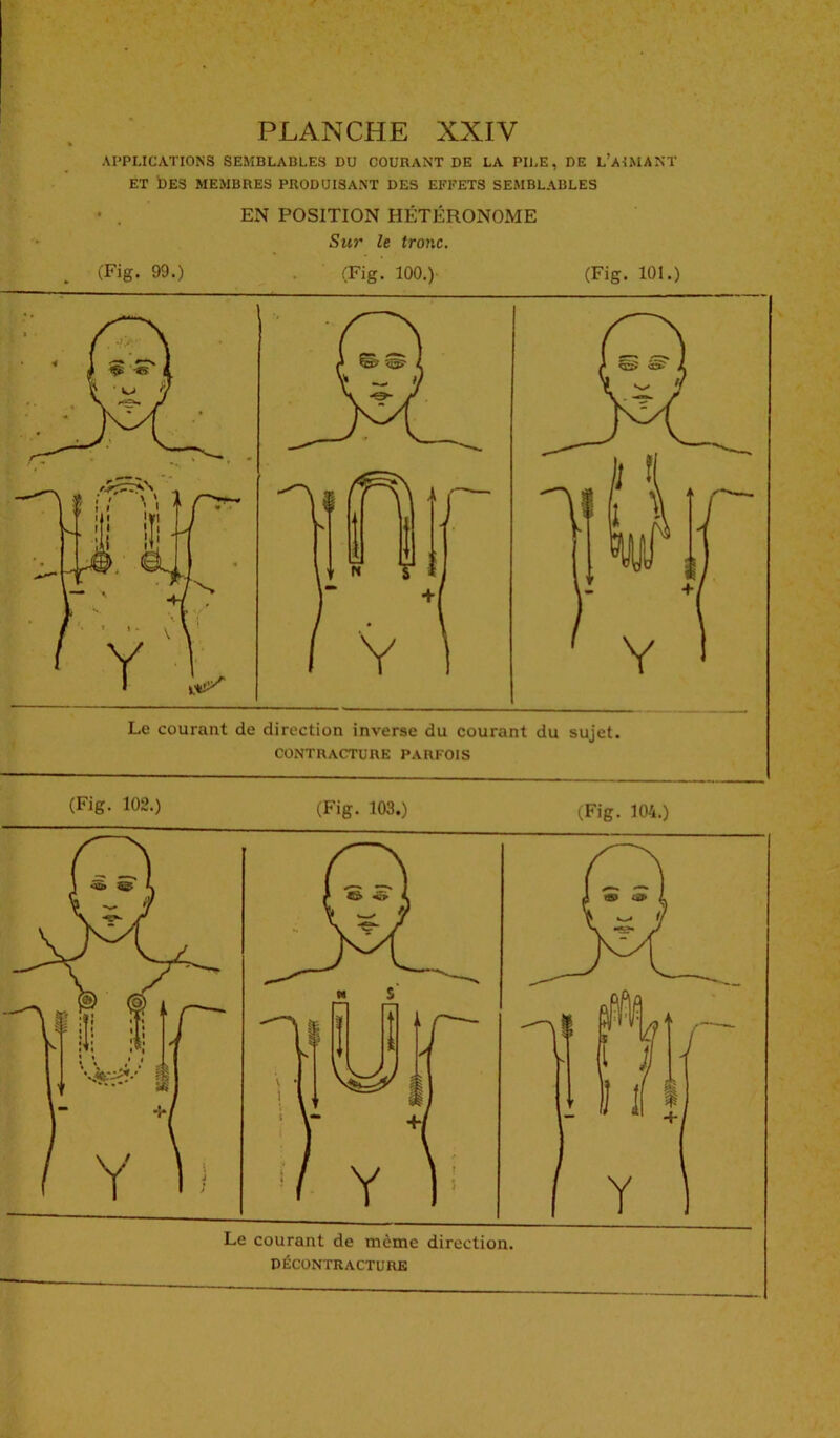 APPLICATIONS SEMBLABLES DU COURANT DE LA PILE, DE L’AIMANT ET DES MEMBRES PRODUISANT DES EFFETS SEMBLABLES • . EN POSITION HÉTÉRONOME Sur le tronc. (Fig. 99.) (Fig. 100.) (Fig. 101.) Le courant de direction inverse du courant du sujet. CONTRACTURE PARFOIS (pi6- 102-) (Fig. 103.) (Fig. 104.) DÉCONTRACTURE