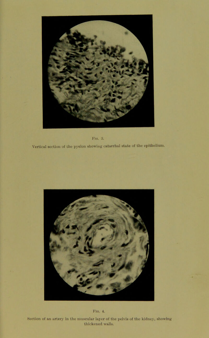 Vertirivl suction of tlic ii.velon sliowiiiK ciilurrlml state of tlie epithelium. 4. Section of an artery in the muscular layer of the peivis of the kitiney, showinif tliU'kcned walls.