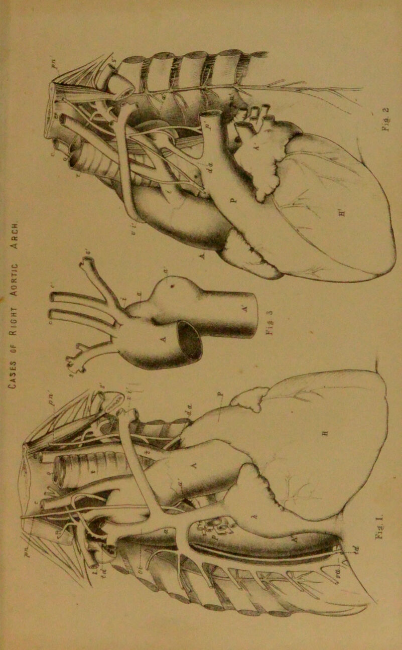 Cases of Right Aortic Arch Fi# 2