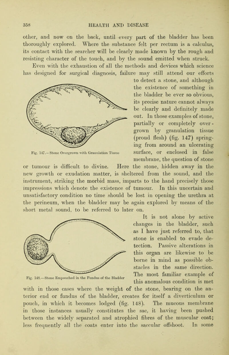 other, and now on the back, until every part of the bladder has been thoroughly explored. Where the substance felt per rectum is a calculus, its contact with the searcher will be clearly made known by the rough and resisting character of the touch, and by the sound emitted when struck. Even with the exhaustion of all the methods and devices which science has designed for surgical diagnosis, failure may still attend our efforts to detect a stone, and although the existence of something in the bladder be ever so obvious, its precise nature cannot always be clearly and definitely made out. In those examples of stone, partially or completely over - grown by granulation tissue (proud flesh) (fig. 147) spring- ing from around an ulcerating surface, or enclosed in false membrane, the question of stone or tumour is difficult to divine. Here the stone, hidden awray in the new growth or exudation matter, is sheltered from the sound, and the instrument, striking the morbid mass, imparts to the hand precisely those impressions which denote the existence of tumour. In this uncertain and unsatisfactory condition no time should be lost in opening the urethra at the perineum, when the bladder may be again explored by means of the short metal sound, to be referred to later on. It is not alone by active changes in the bladder, such as I have just referred to, that stone is enabled to evade de- tection. Passive alterations in this organ are likewise to be borne in mind as possible ob- stacles in the same direction. The most familiar example of this anomalous condition is met with in those cases where the weight of the stone, bearing on the an- terior end or fundus of the bladder, creates for itself a diverticulum or pouch, in which it becomes lodged (fig. 148). The mucous membrane in those instances usually constitutes the sac, it having been pushed between the widely separated and atrophied fibres of the muscular coat; less frequently all the coats enter into the saccular offshoot. In some Fig. 148..—Stone Empouched in the Fundus of the Bladder Fig. 147.—Stone Overgrown with Granulation Tissue