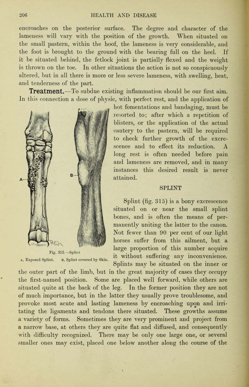 encroaches on the posterior surface. The degree and character of the lameness will vary with the position of the growth. When situated on the small pastern, within the hoof, the lameness is very considerable, and the foot is brought to the ground with the bearing full on the heel. If it be situated behind, the fetlock joint is partially Hexed and the weight is thrown on the toe. In other situations the action is not so conspicuously altered, but in all there is more or less severe lameness, with swelling, heat, and tenderness of the part. Treatment.—To subdue existing inflammation should be our first aim. In this connection a dose of physic, with perfect rest, and the application of hot fomentations and bandaging, must be resorted to; after which a repetition of blisters, or the application of the actual cautery to the pastern, will be required to check further growth of the excre- scence and to effect its reduction. A long rest is often needed before pain and lameness are removed, and in many instances this desired result is never attained. SPLINT Splint (fig. 315) is a bony excrescence situated on or near the small splint bones, and is often the means of per- manently uniting the latter to the canon. Not fewer than 90 per cent of our light horses suffer from this ailment, but a large proportion of this number acquire it without suffering any inconvenience. Splints may be situated on the inner or the outer part of the limb, but in the great majority of cases they occupy the first-named position. Some are placed well forward, while others are situated quite at the back of the leg. In the former position they are not of much importance, but in the latter they usually prove troublesome, and provoke most acute and lasting lameness by encroaching upon and irri- tating the ligaments and tendons there situated. These growths assume a variety of forms. Sometimes they are very prominent and project from a narrow base, at others they are quite flat and diffused, and consequently with difficulty recognized. There may be only one large one, or several smaller ones may exist, placed one below another along the course of the Fig. 315.—Splint a, Exposed Splint. B, Splint covered by Skin.