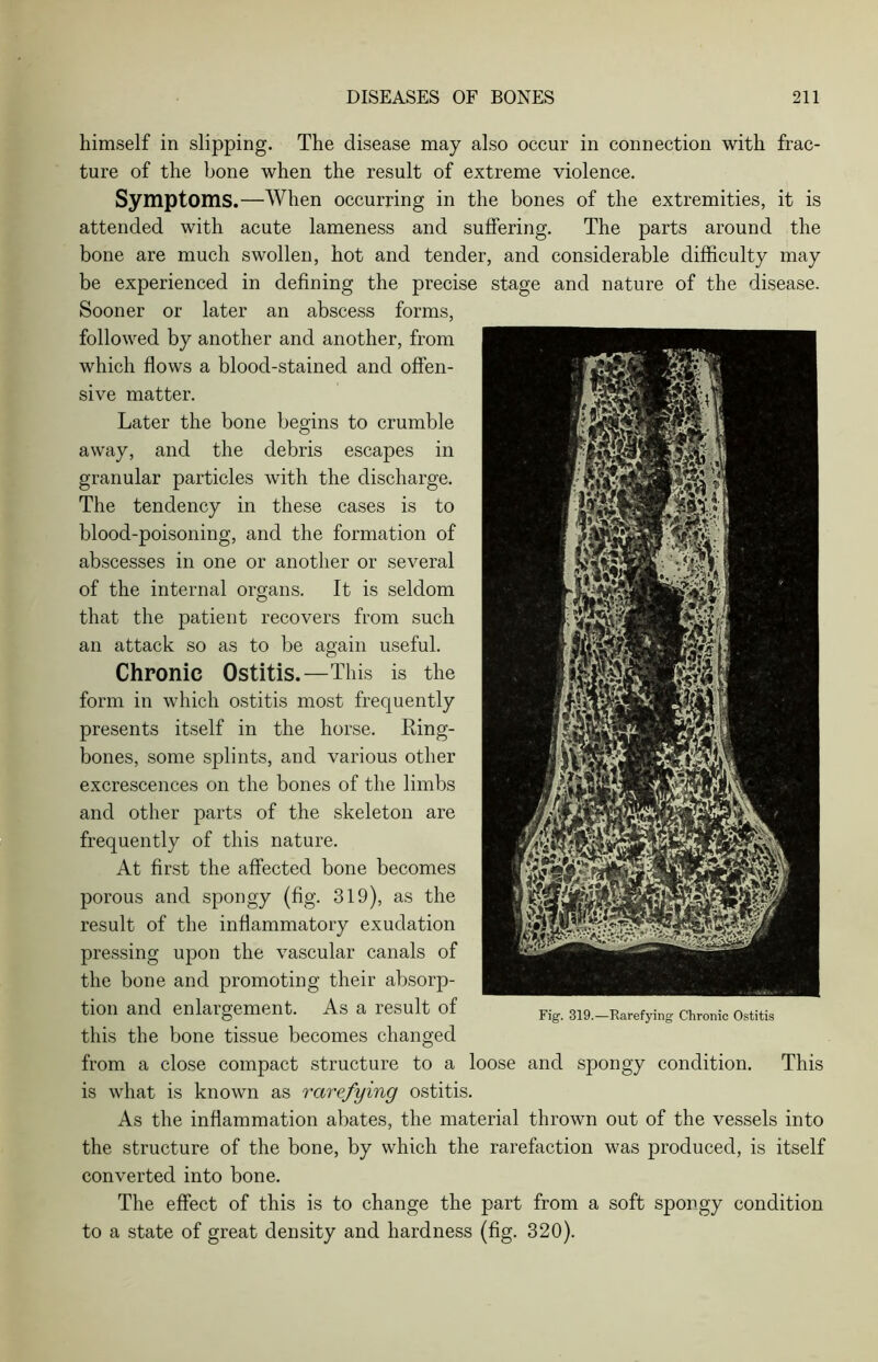 himself in slipping. The disease may also occur in connection with frac- ture of the bone when the result of extreme violence. Symptoms.—When occurring in the bones of the extremities, it is attended with acute lameness and suffering. The parts around the bone are much swollen, hot and tender, and considerable difficulty may be experienced in defining the precise stage and nature of the disease. Sooner or later an abscess forms, followed by another and another, from which flows a blood-stained and offen- sive matter. Later the bone begins to crumble away, and the debris escapes in granular particles with the discharge. The tendency in these cases is to blood-poisoning, and the formation of abscesses in one or another or several of the internal organs. It is seldom that the patient recovers from such an attack so as to be again useful. Chronic Ostitis.—This is the form in which ostitis most frequently presents itself in the horse. Ring- bones, some splints, and various other excrescences on the bones of the limbs and other parts of the skeleton are frequently of this nature. At first the affected bone becomes porous and spongy (fig. 319), as the result of the inflammatory exudation pressing upon the vascular canals of the bone and promoting their absorp- tion and enlargement. As a result of Fig 319._Rarefying Chronic 0stitis this the bone tissue becomes changed from a close compact structure to a loose and spongy condition. This is what is known as rarefying ostitis. As the inflammation abates, the material thrown out of the vessels into the structure of the bone, by which the rarefaction was produced, is itself converted into bone. The effect of this is to change the part from a soft spongy condition to a state of great density and hardness (fig. 320).