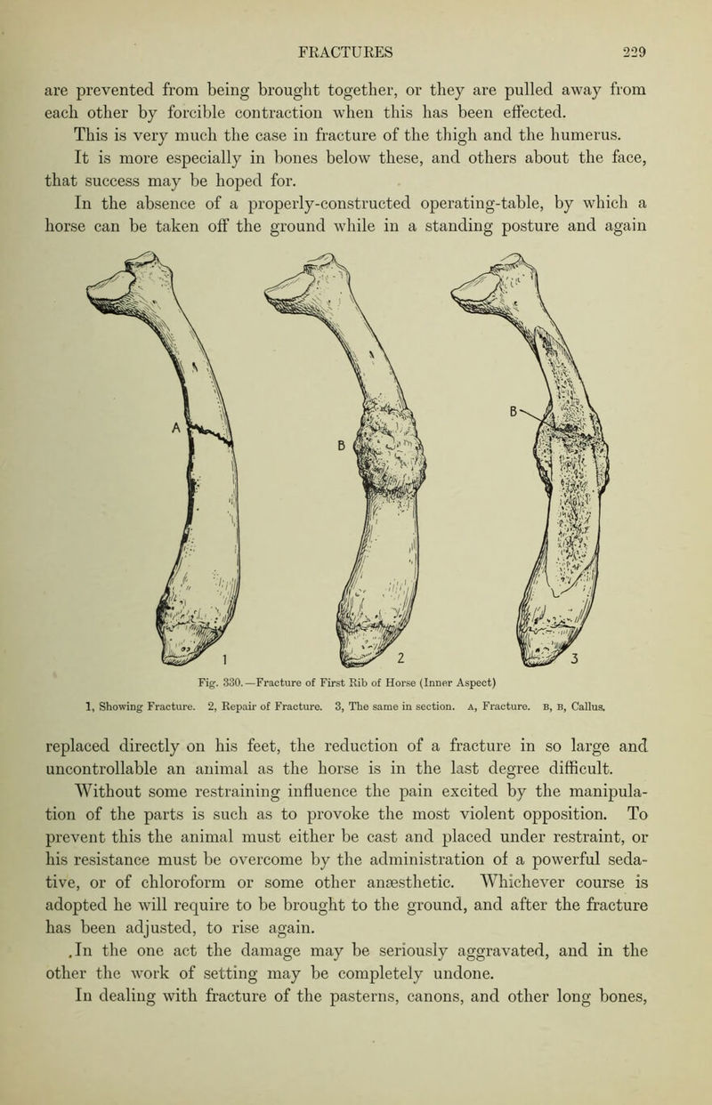 are prevented from being brought together, or they are pulled away from each other by forcible contraction when this has been effected. This is very much the case in fracture of the thigh and the humerus. It is more especially in bones below these, and others about the face, that success may be hoped for. In the absence of a properly-constructed operating-table, by which a horse can be taken off the ground while in a standing posture and again 1, Showing Fracture. 2, Repair of Fracture. 3, The same in section, a, Fracture, b, b, Callus. replaced directly on his feet, the reduction of a fracture in so large and uncontrollable an animal as the horse is in the last degree difficult. Without some restraining influence the pain excited by the manipula- tion of the parts is such as to provoke the most violent opposition. To prevent this the animal must either be cast and placed under restraint, or his resistance must be overcome by the administration of a powerful seda- tive, or of chloroform or some other anaesthetic. Whichever course is adopted he will require to be brought to the ground, and after the fracture has been adjusted, to rise again. ,In the one act the damage may be seriously aggravated, and in the other the work of setting may be completely undone. In dealing with fracture of the pasterns, canons, and other long bones,