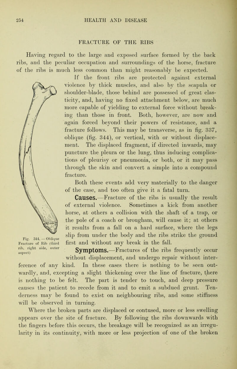 FRACTURE OF THE RIBS Having regard to the large and exposed surface formed by the back ribs, and the peculiar occupation and surroundings of the horse, fracture of the ribs is much less common than might reasonably be expected. If the front ribs are protected against external violence by thick muscles, and also by the scapula or shoulder-blade, those behind are possessed of great elas- ticity, and, having no fixed attachment below, are much more capable of yielding to external force without break- ing than those in front. Both, however, are now and again forced beyond their powers of resistance, and a fracture follows. This may be transverse, as in fig. 337, oblique (fig. 344), or vertical, with or without displace- ment. The displaced fragment, if directed inwards, may puncture the pleura or the lung, thus inducing complica- tions of pleurisy or pneumonia, or both, or it may pass through the skin and convert a simple into a compound fracture. Both these events add very materially to the danger of the case, and too often give it a fatal turn. Causes.—Fracture of the ribs is usually the result of external violence. Sometimes a kick from another horse, at others a collision with the shaft of a trap, or the pole of a coach or brougham, will cause it; at others it results from a fall on a hard surface, where the legs slip from under the body and the ribs strike the ground first and without any break in the fall. Symptoms.—Fractures of the ribs frequently occur without displacement, and undergo repair without inter- ference of any kind. In these cases there is nothing to be seen out- wardly, and, excepting a slight thickening over the line of fracture, there is nothing to be felt. The part is tender to touch, and deep pressure causes the patient to recede from it and to emit a subdued grunt. Ten- derness may be found to exist on neighbouring ribs, and some stiffness will be observed in turning. Where the broken parts are displaced or contused, more or less swelling appears over the site of fracture. By following the ribs downwards with the fingers before this occurs, the breakage will be recognized as an irregu- larity in its continuity, with more or less projection of one of the broken Fig. 344. — Oblique Fracture of Rib (third rib, right side, outer aspect)