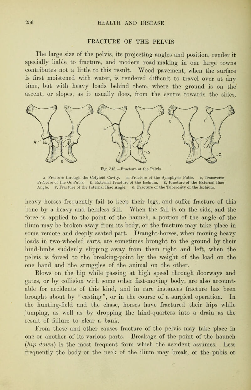 FRACTURE OF THE PELVIS The large size of the pelvis, its projecting angles and position, render it specially liable to fracture, and modern road-making in our large towns contributes not a little to this result. Wood pavement, when the surface is first moistened with water, is rendered difficult to travel over at any time, but with heavy loads behind them, where the ground is on the ascent, or slopes, as it usually does, from the centre towards the sides, Fig. 345.—Fracture ol the Pelvis a, Fracture through the Cotyloid Cavity. B, Fracture of the Symphysis Pubis. c, Transverse Fracture of the Os Pubis. D, External Fracture of the Ischium. E, Fracture of the External Iliac Angle. F, Fracture of the Internal Iliac Angle, g, Fracture of the Tuberosity of the Ischium. heavy horses frequently fail to keep their legs, and suffer fracture of this bone by a heavy and helpless fall. When the fall is on the side, and the force is applied to the point of the haunch, a portion of the angle of the ilium may be broken away from its body, or the fracture may take place in some remote and deeply seated part. Draught-horses, when moving heavy loads in two-wheeled carts, are sometimes brought to the ground by their hind-limbs suddenly slipping away from them right and left, when the pelvis is forced to the breaking-point by the weight of the load on the one hand and the struggles of the animal on the other. Blows on the hip while passing at high speed through doorways and gates, or by collision with some other fast-moving body, are also account- able for accidents of this kind, and in rare instances fracture has been brought about by “casting”, or in the course of a surgical operation. In the hunting-field and the chase, horses have fractured their hips while jumping, as well as by dropping the hind-quarters into a drain as the result of failure to clear a bank. From these and other causes fracture of the pelvis may take place in one or another of its various parts. Breakage of the point of the haunch (hip down) is the most frequent form which the accident assumes. Less frequently the body or the neck of the ilium may break, or the pubis or