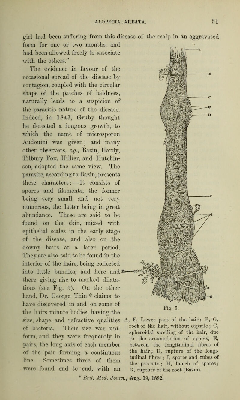girl had been suffering from this disease of the scalp in an aggravated form for one or two months, and had been allowed freely to associate with the others.” The evidence in favour of the occasional spread of the disease by contagion, coupled with the circular shape of the patches of baldness, naturally leads to a suspicion of the parasitic nature of the disease. Indeed, in 1843, Gruby thought he detected a fungous growth, to which the name of microsporon Audouini was given; and many other observers, e.g., Bazin, Hardy, Tilbury Fox, Hillier, and Hutchin- son, adopted the same view. The parasite, according to Bazin, presents these characters :—It consists of spores and filaments, the former being very small and not very numerous, the latter being in great abundance. These are said to be found on the skin, mixed with epithelial scales in the early stage of the disease, and also on the downy hairs at a later period. They are also said to be found in the interior of the hairs, being collected into little bundles, and here and there giving rise to marked dilata- tions (see Fig. 5). On the other hand, Dr. George Thin * claims to have discovered in and on some of the hairs minute bodies, having the Fig. 5. size, shape, and refractive qualities A, F, Lower part of the hair; F, G, of bacteria. Their size was uni- form, and they were frequently in pairs, the long axis of each member of the pair forming a continuous line. Sometimes three of them were found end to end, with an root of the hair, without capsule; C, spheroidal swelling of the hair, due to the accumulation of spores, E, between the longitudinal fibres of the hair; D, rupture of the longi- tudinal fibres ; I, spores and tubes of the parasite; H, bunch of spores; G, rupture of the root (Bazin). Brit. Med. JournAug. 19, 1882.