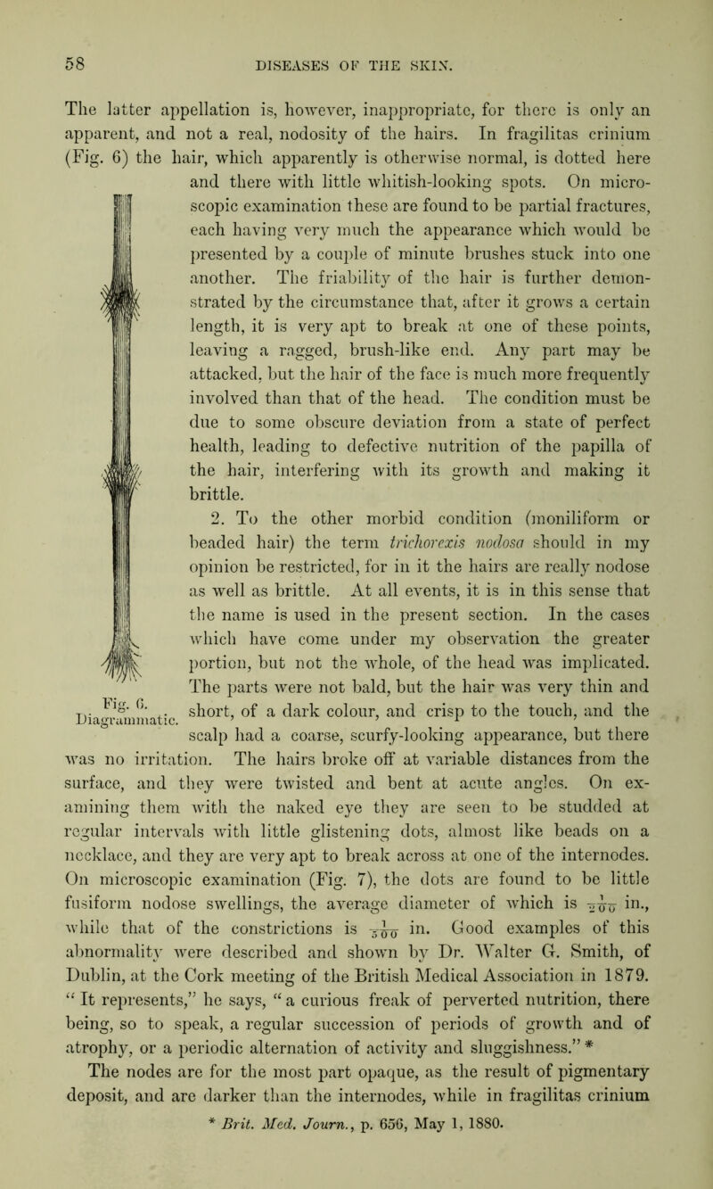 The latter appellation is, however, inappropriate, for there is only an apparent, and not a real, nodosity of the hairs. In fragilitas crinium (Fig. 6) the hair, which apparently is otherwise normal, is dotted here and there with little whitish-looking spots. On micro- scopic examination these are found to be partial fractures, each having very much the appearance which would be presented by a couple of minute brushes stuck into one another. The friability of the hair is further demon- strated by the circumstance that, after it grows a certain length, it is very apt to break at one of these points, leaving a ragged, brush-like end. Any part may be attacked, but the hair of the face is much more frequently involved than that of the head. The condition must be due to some obscure deviation from a state of perfect health, leading to defective nutrition of the papilla of the hair, interfering with its growth and making it brittle. 2. To the other morbid condition (moniliform or beaded hair) the term trichorexis nodosa should in my opinion be restricted, for in it the hairs are really nodose as well as brittle. At all events, it is in this sense that the name is used in the present section. In the cases which have come under my observation the greater portion, but not the whole, of the head was implicated. The parts were not bald, but the hair was very thin and short, of a dark colour, and crisp to the touch, and the scalp had a coarse, scurfy-looking appearance, but there was no irritation. The hairs broke off at variable distances from the surface, and they were twisted and bent at acute angles. On ex- amining them with the naked eye they are seen to be studded at regular intervals with little glistening dots, almost like beads on a necklace, and they are very apt to break across at one of the internodes. On microscopic examination (Fig. 7), the dots are found to be little fusiform nodose swellings, the average diameter of which is -^io in-> while that of the constrictions is in. Good examples of this abnormality were described and shown by Dr. Walter G. Smith, of Dublin, at the Cork meeting of the British Medical Association in 1879. “ It represents,” he says, “ a curious freak of perverted nutrition, there being, so to speak, a regular succession of periods of growth and of atrophy, or a periodic alternation of activity and sluggishness.” * The nodes are for the most part opaque, as the result of pigmentary deposit, and are darker than the internodes, while in fragilitas crinium * Brit. Med. Journ., p. 656, May 1, 1880. Diagrammatic.