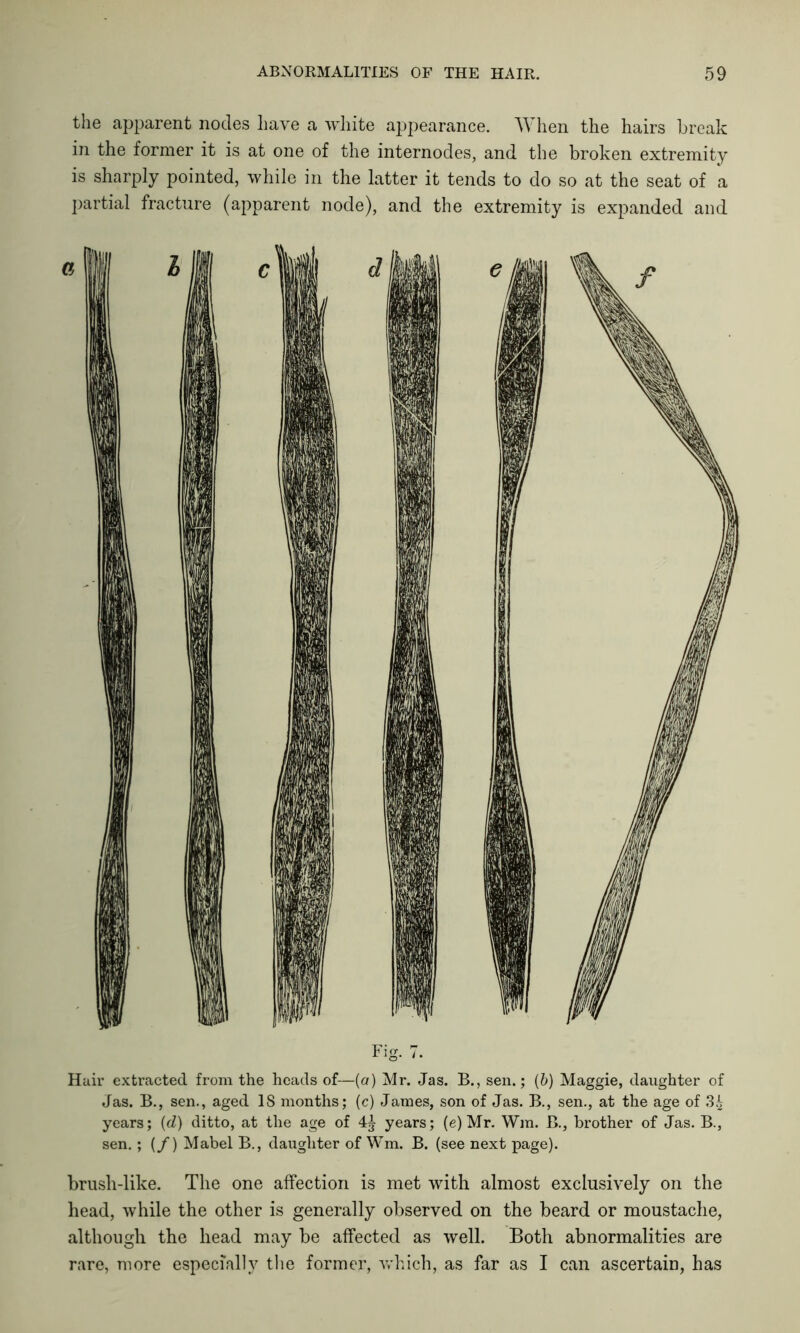 the apparent nodes have a white appearance. When the hairs break in the former it is at one of the internodes, and the broken extremity is sharply pointed, while in the latter it tends to do so at the seat of a partial fracture (apparent node), and the extremity is expanded and Hair extracted from the heads of—(a) Mr. Jas. B., sen.; (b) Maggie, daughter of Jas. B., sen., aged IS months; (c) James, son of Jas. B., sen., at the age of 3£ years; (d,) ditto, at the age of 4^ years; (e) Mr. Win. B., brother of Jas. B., sen.; (/) Mabel B., daughter of Wm. B. (see next page). brush-like. The one affection is met with almost exclusively on the head, while the other is generally observed on the beard or moustache, although the head may be affected as well. Both abnormalities are rare, more especially the former, which, as far as I can ascertain, has