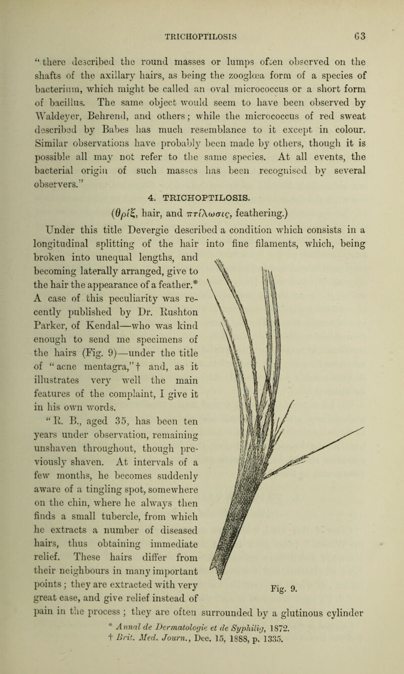 TRICHOPTILOSIS G3 “ there described the round masses or lumps often observed on the shafts of the axillary hairs, as being the zooglcea form of a species of bacterium, which might be called an oval micrococcus or a short form of bacillus. The same object would seem to have been observed by Waldeyer, Behrend, and others; while the micrococcus of red sweat described by Babes has much resemblance to it except in colour. Similar observations have probably been made by others, though it is possible all may not refer to the same species. At all events, the bacterial origin of such masses has been recognised by several observers.” 4. TRICHOPTILOSIS. hair, and feathering.) Under this title Devergie described a condition which consists in a longitudinal splitting of the hair into fine filaments, which, being broken into unequal lengths, and becoming laterally arranged, give to the hair the appearance of a feather.* A case of this peculiarity was re- cently published by Dr. Bushton Parker, of Kendal—who was kind enough to send me specimens of the hairs (Fig. 9)—under the title of “ acne mentagra,” f and, as it illustrates very well the main features of the complaint, I give it in his own words. “E. B., aged 35, has been ten years under observation, remaining unshaven throughout, though pre- viously shaven. At intervals of a few months, he becomes suddenly aware of a tingling spot, somewhere on the chin, where he always then finds a small tubercle, from which he extracts a number of diseased hairs, thus obtaining immediate relief. These hairs differ from their neighbours in many important points; they are extracted with very great ease, and give relief instead of pain in the process ; they are often surrounded by a glutinous cylinder * Annal de Dermatologie et de Syphilig, 1S72. + Brit. Med. Journ., Dec. 15, 1888, p. 1335.